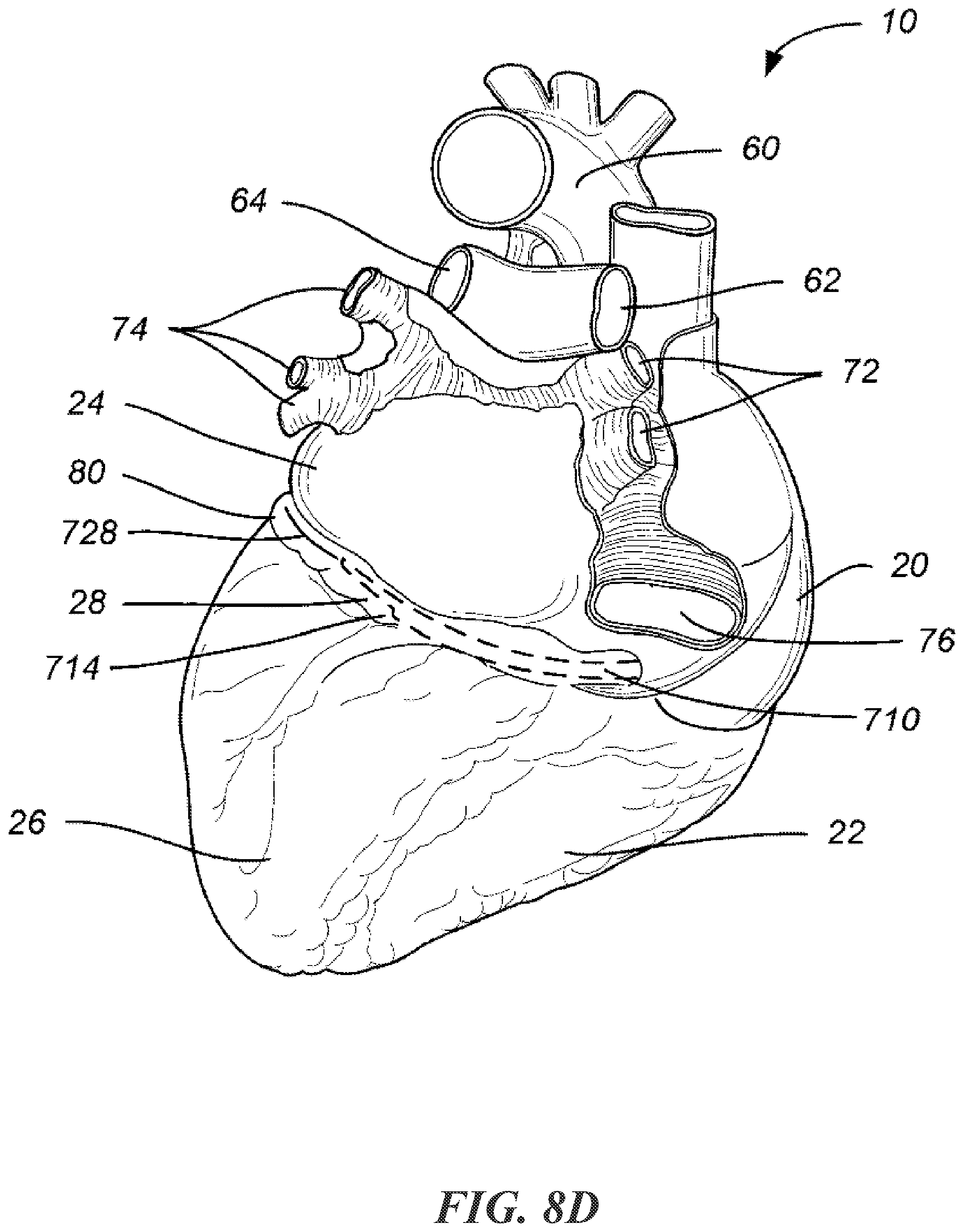Patent US12303684 Figure 16 – Transcoronary sinus pacing of posteroseptal left ventricular base