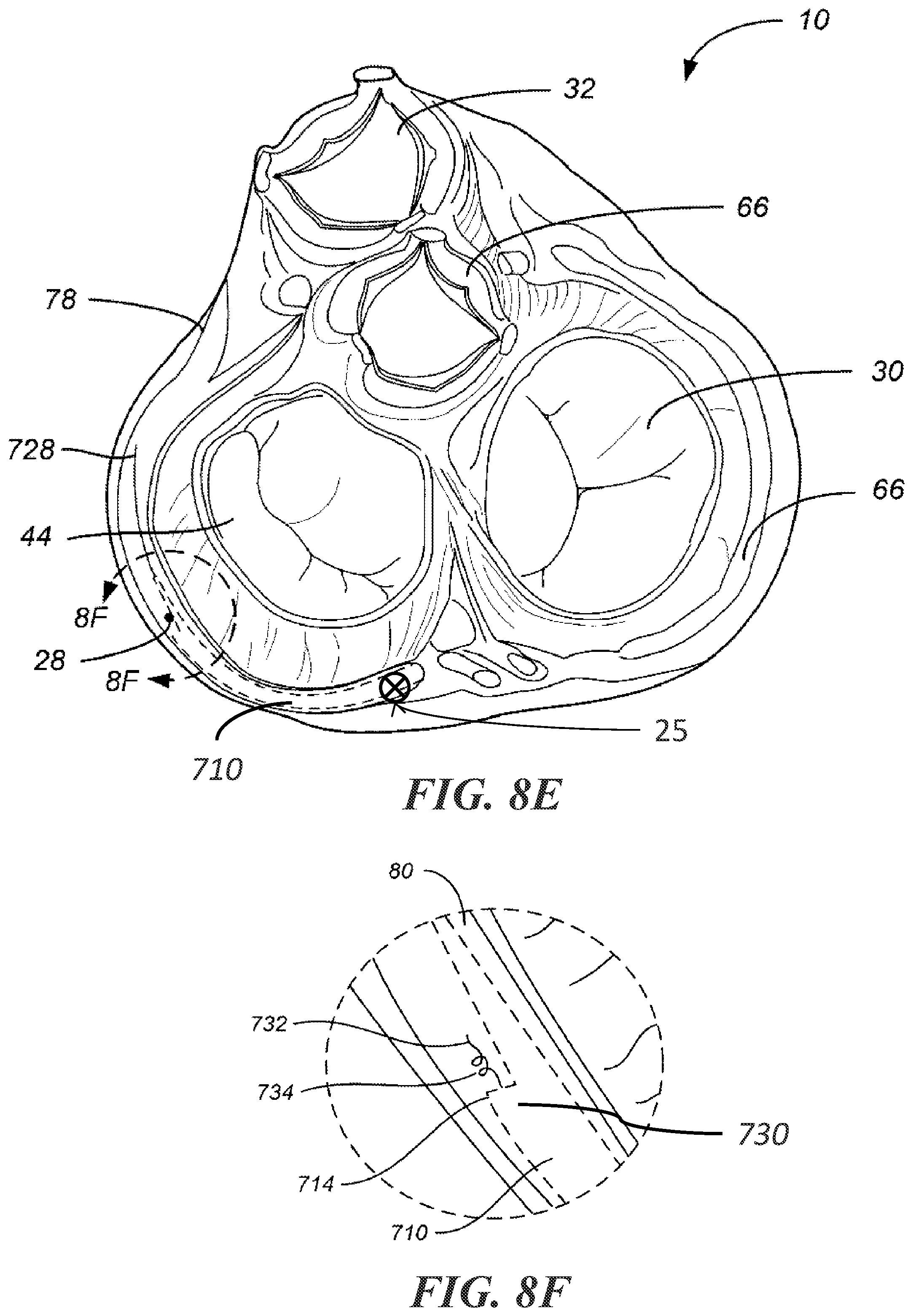 Patent US12303684 Figure 17 – Transcoronary sinus pacing of posteroseptal left ventricular base
