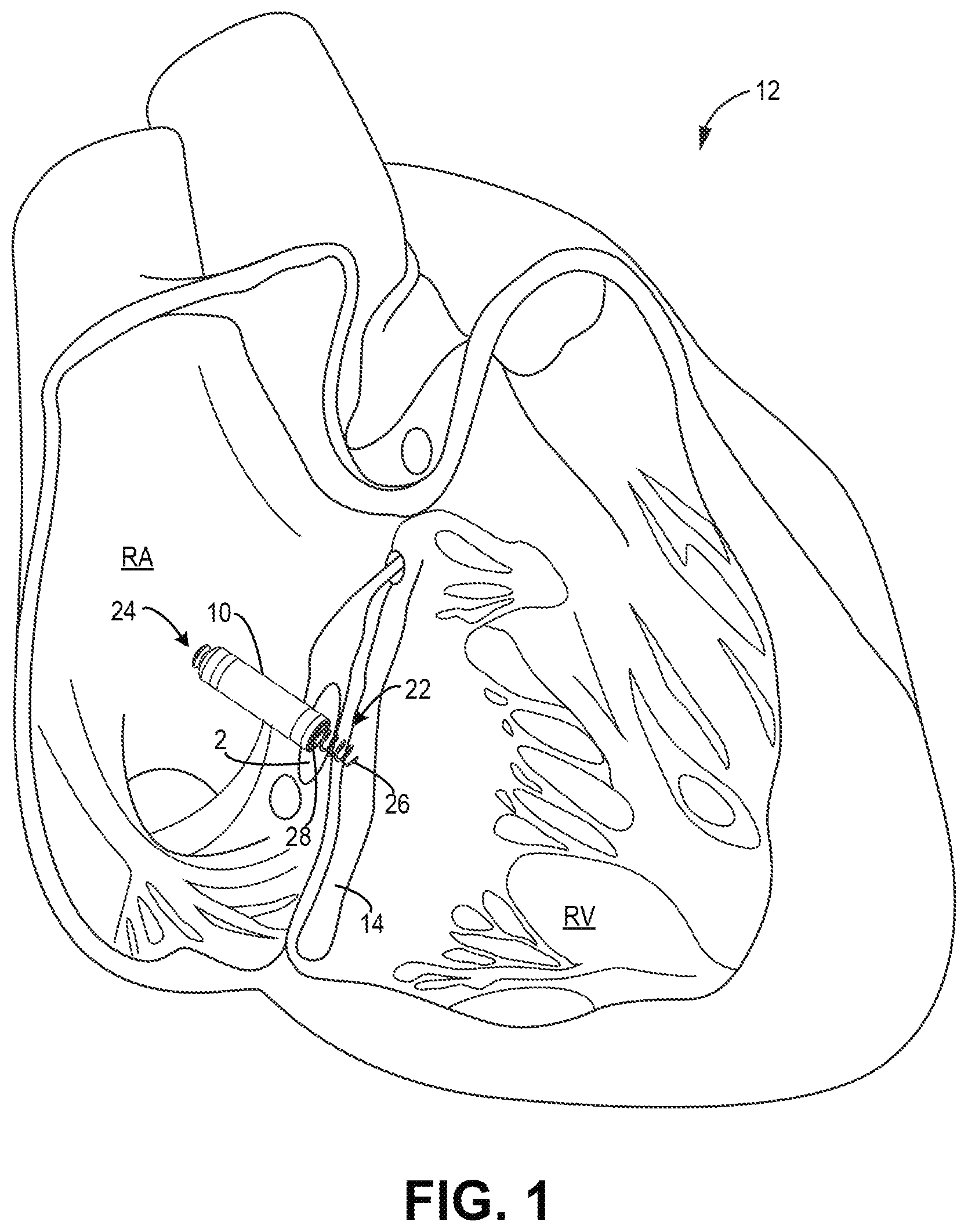 Patent US12303685 Figure 1 – Electrode configuration for a medical device