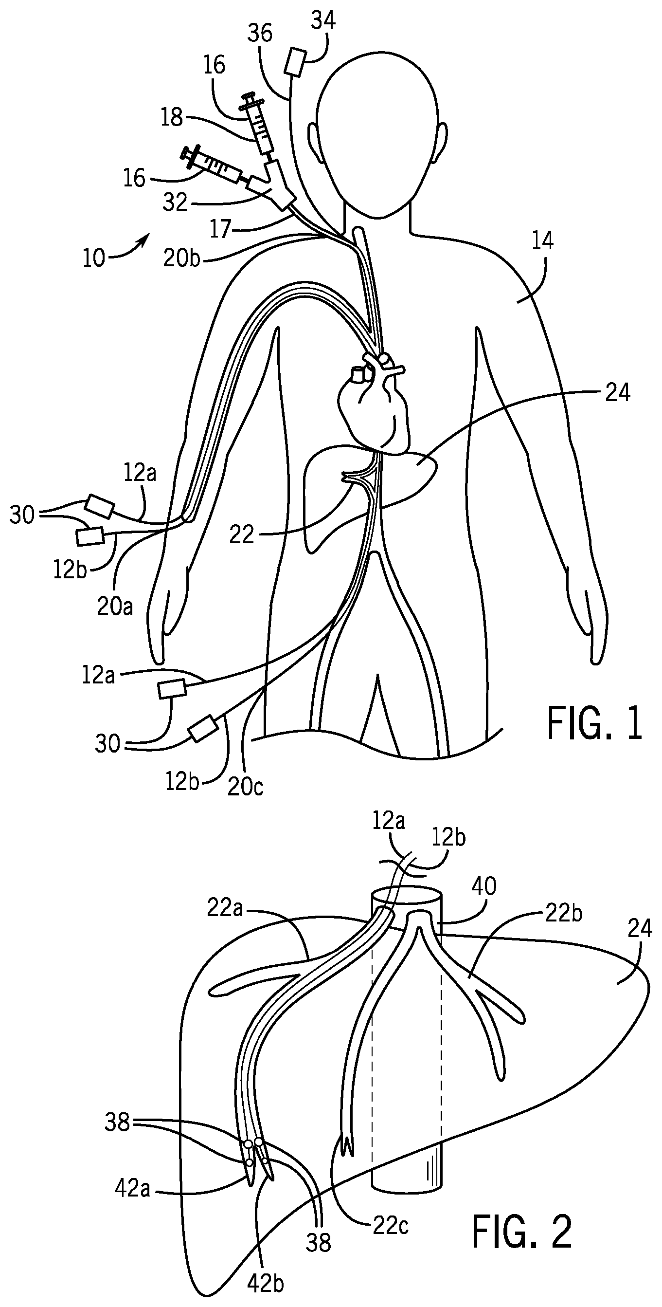 Patent US12303687 Figure 1 – In vivo gene therapy delivery procedure and device