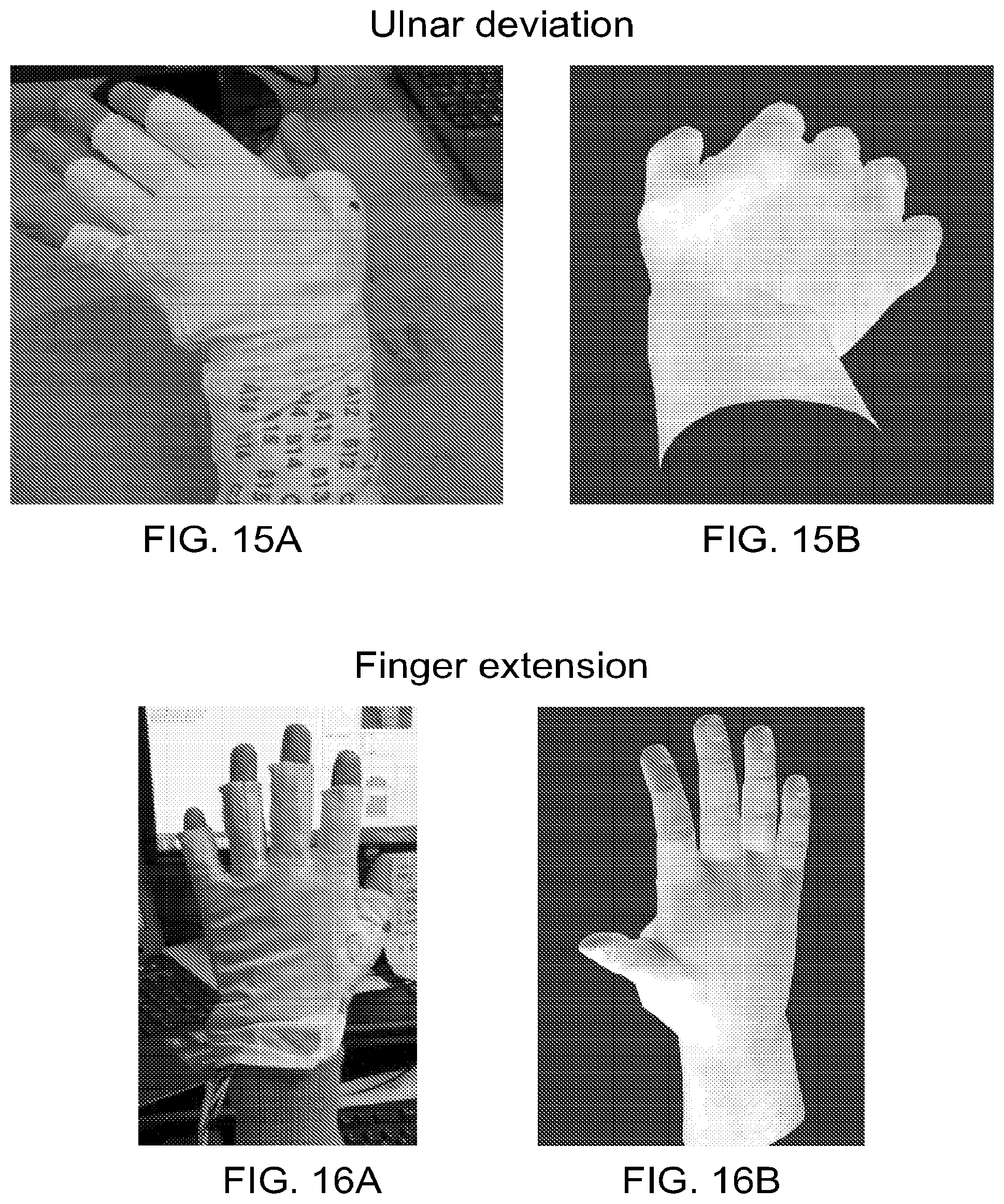 Patent US12303688 Figure 11 – Systems for neural bridging of the nervous system