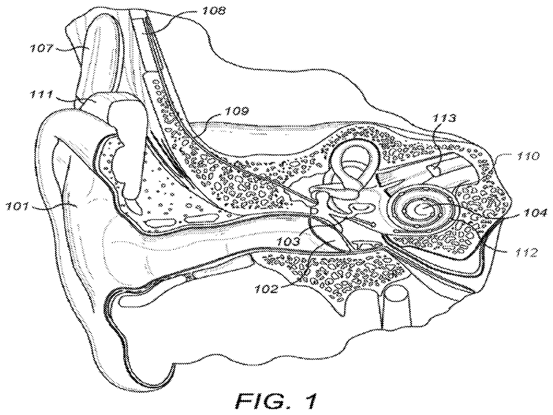 Patent US12303689 Figure 1 – Polyphonic pitch enhancement in a cochlear implant