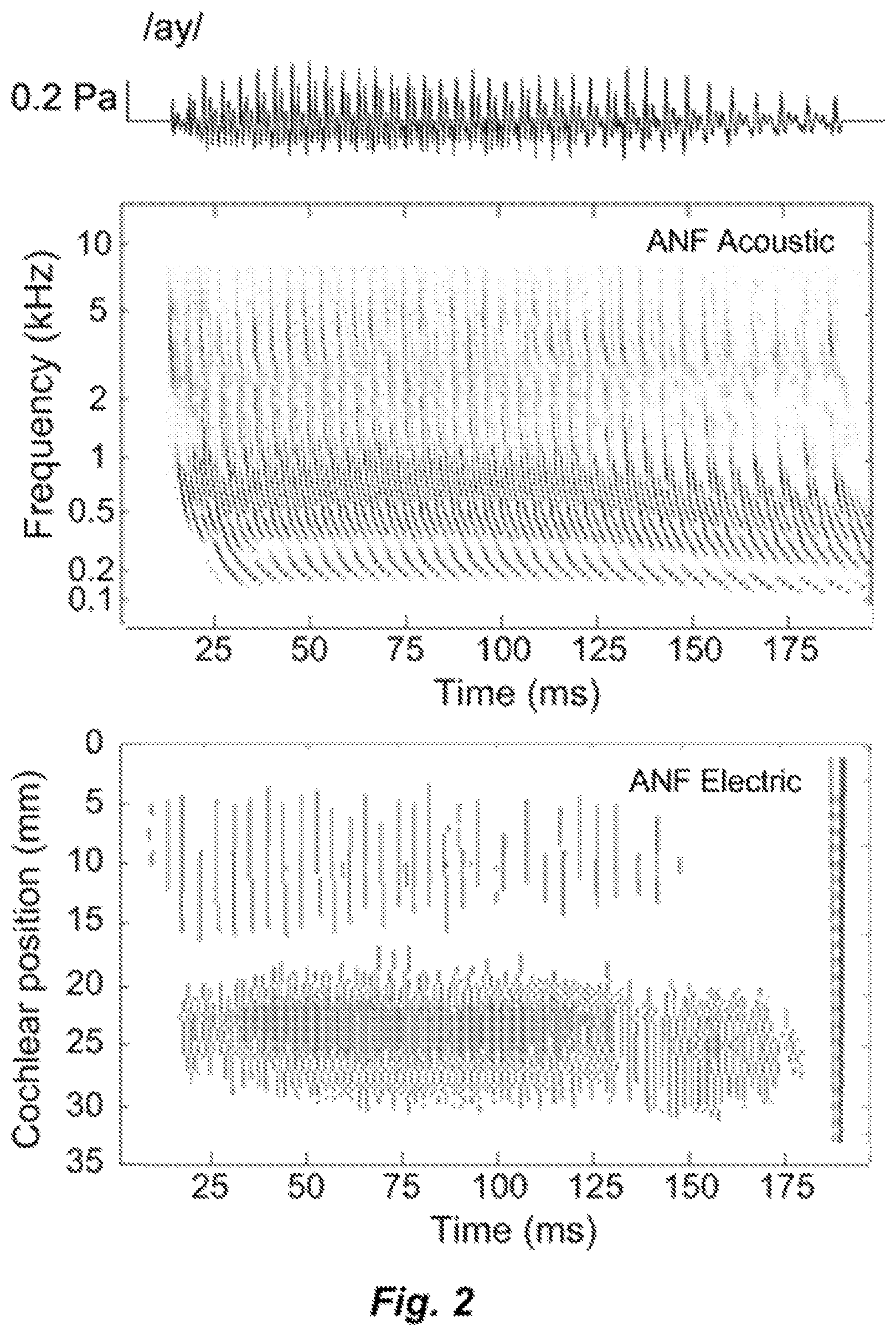 Patent US12303689 Figure 2 – Polyphonic pitch enhancement in a cochlear implant