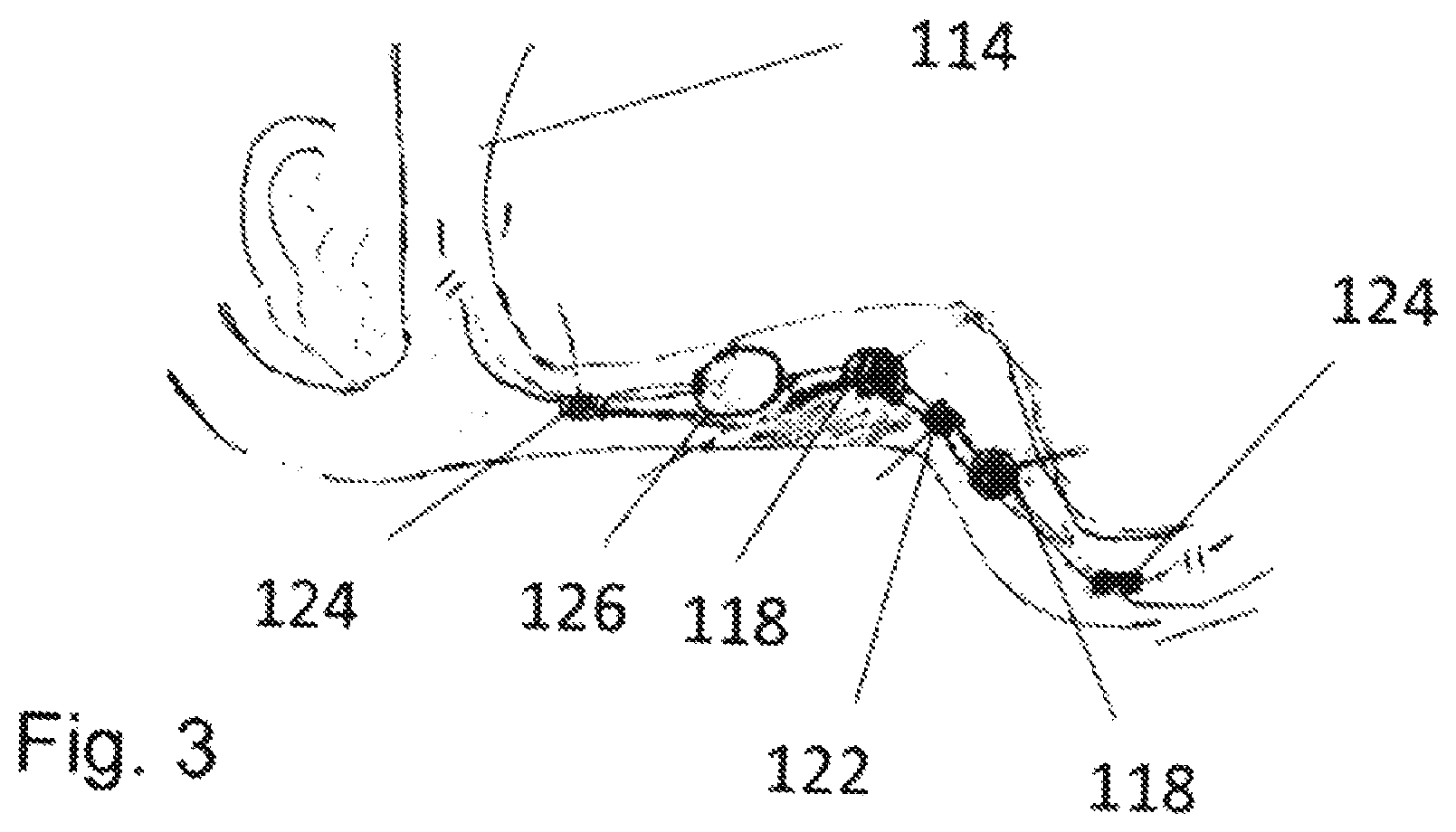 Patent US12303691 Figure 3 – Device and method for determining sleep apnea