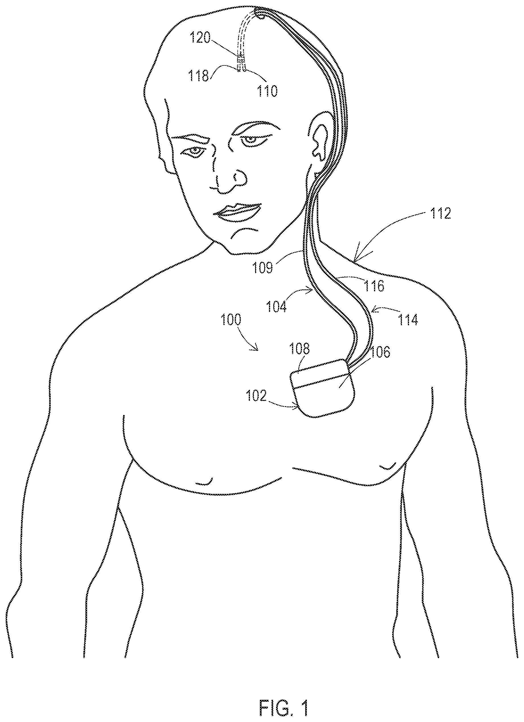 Patent US12303692 — Devices and methods for sensing physiological signals during stimulation therapy — Figure 1
