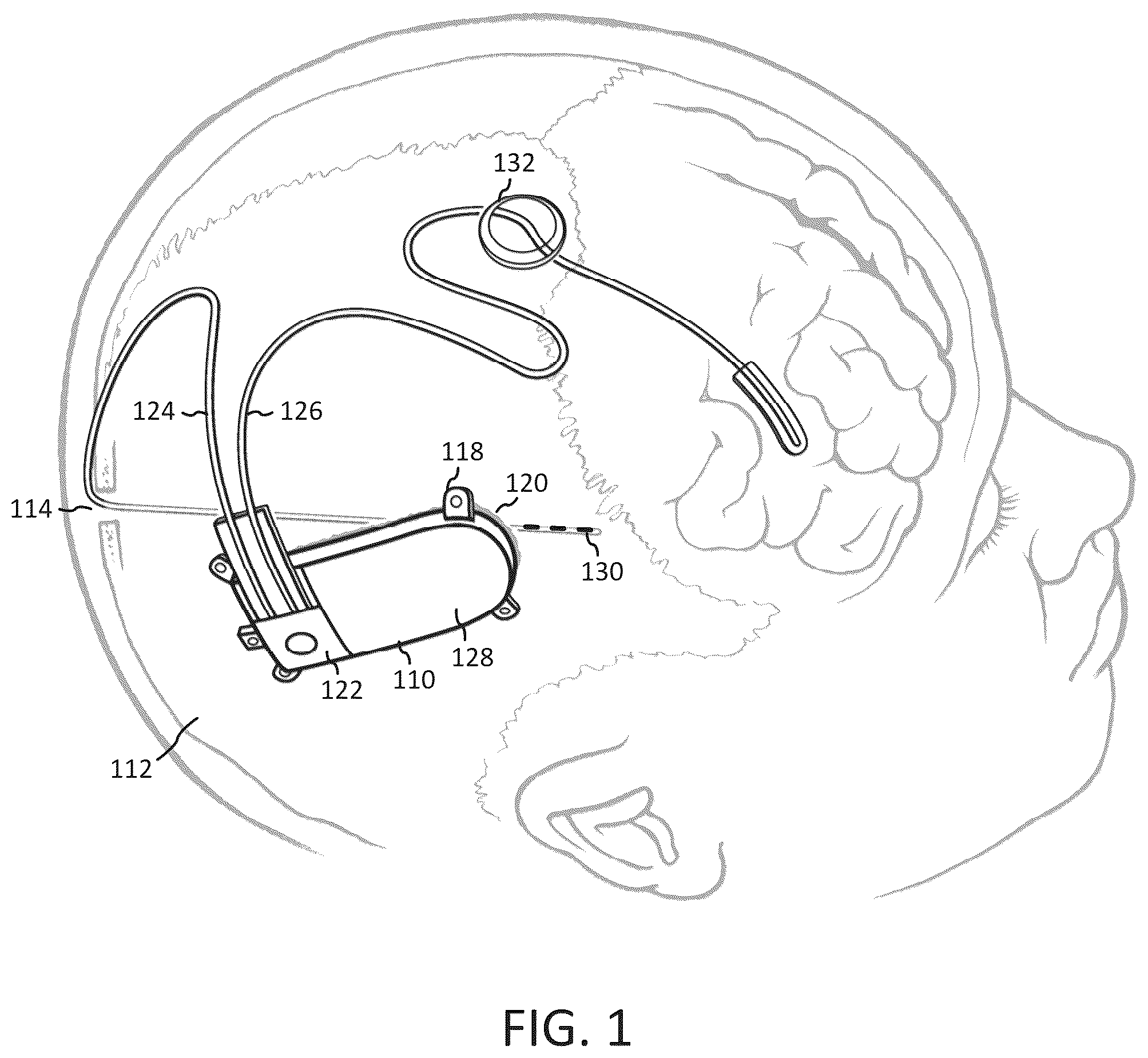 Patent US12303694 Figure 1 – Methods and systems for optimizing therapy using stimulation mimicking natural seizures
