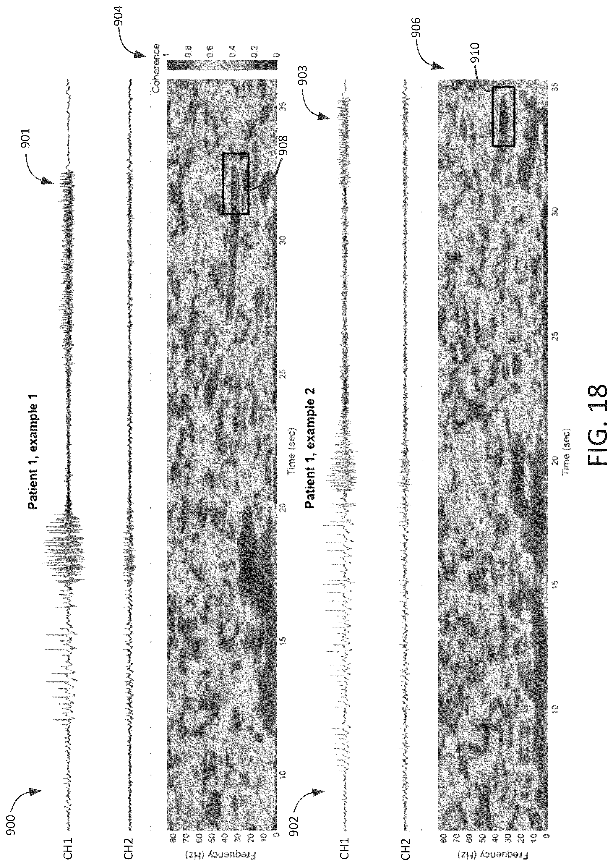 Patent US12303694 Figure 17 – Methods and systems for optimizing therapy using stimulation mimicking natural seizures