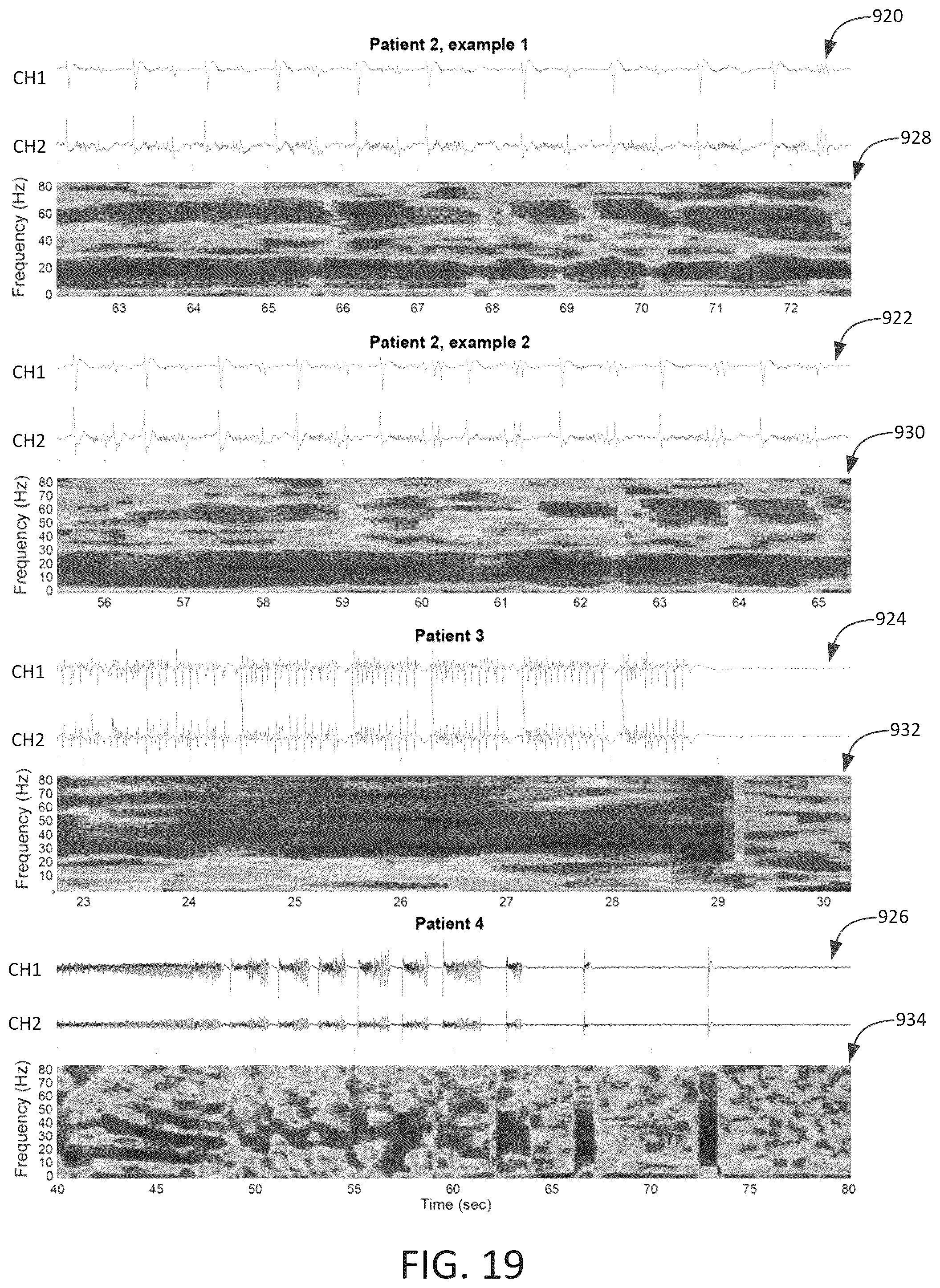 Patent US12303694 Figure 18 – Methods and systems for optimizing therapy using stimulation mimicking natural seizures