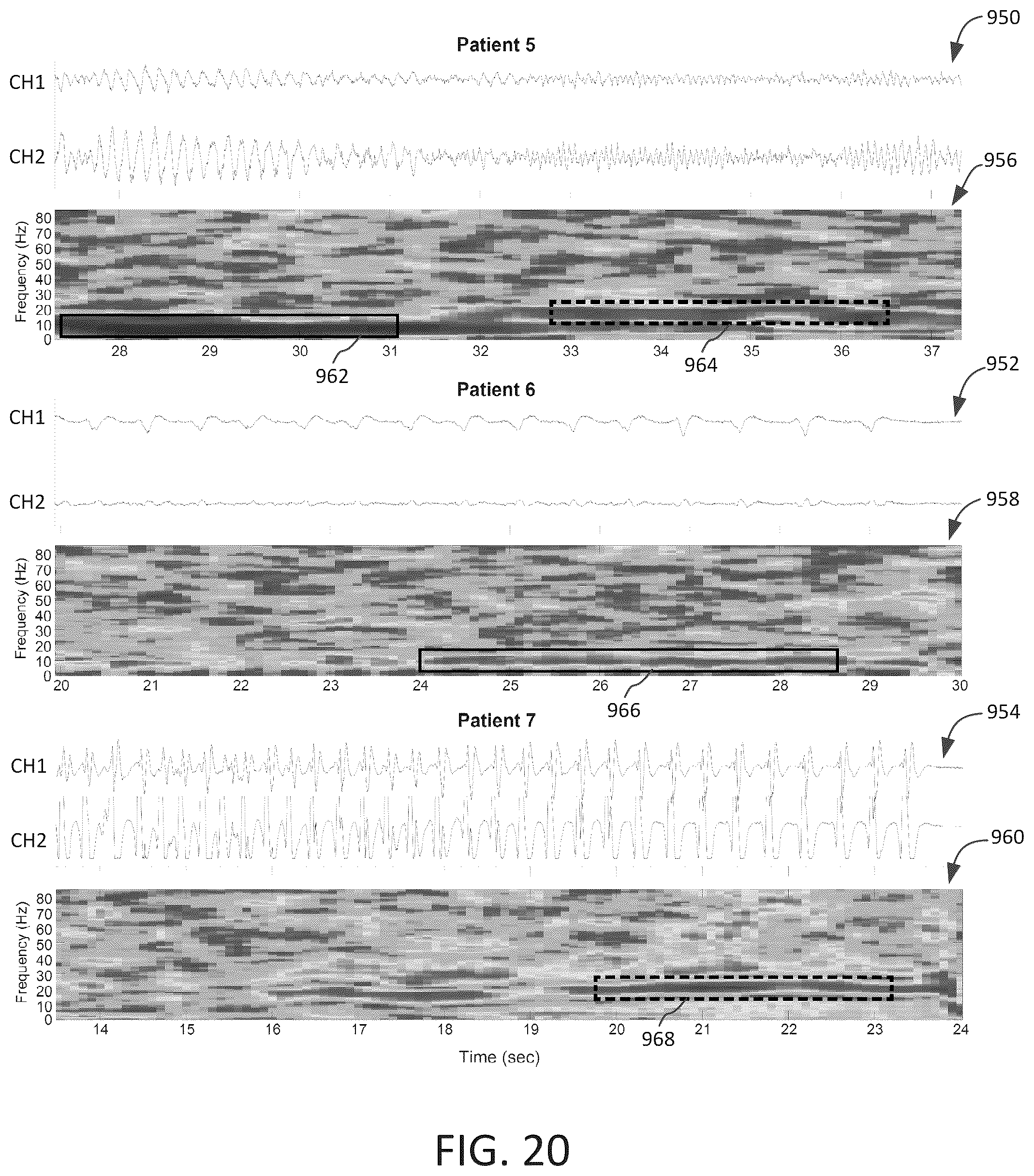 Patent US12303694 Figure 19 – Methods and systems for optimizing therapy using stimulation mimicking natural seizures