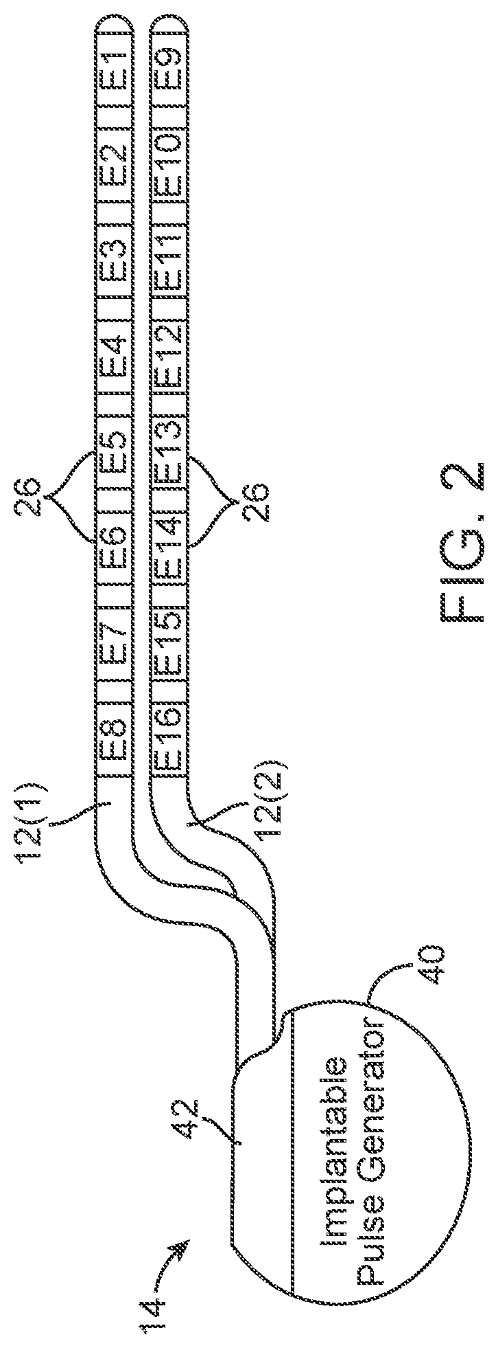 Patent US12303695 Figure 2 – Systems and methods of providing modulation therapy without patient-perception of stimulation
