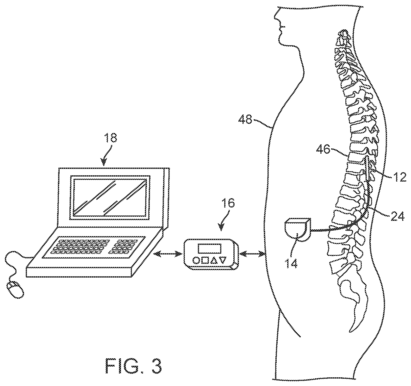 Patent US12303695 Figure 3 – Systems and methods of providing modulation therapy without patient-perception of stimulation