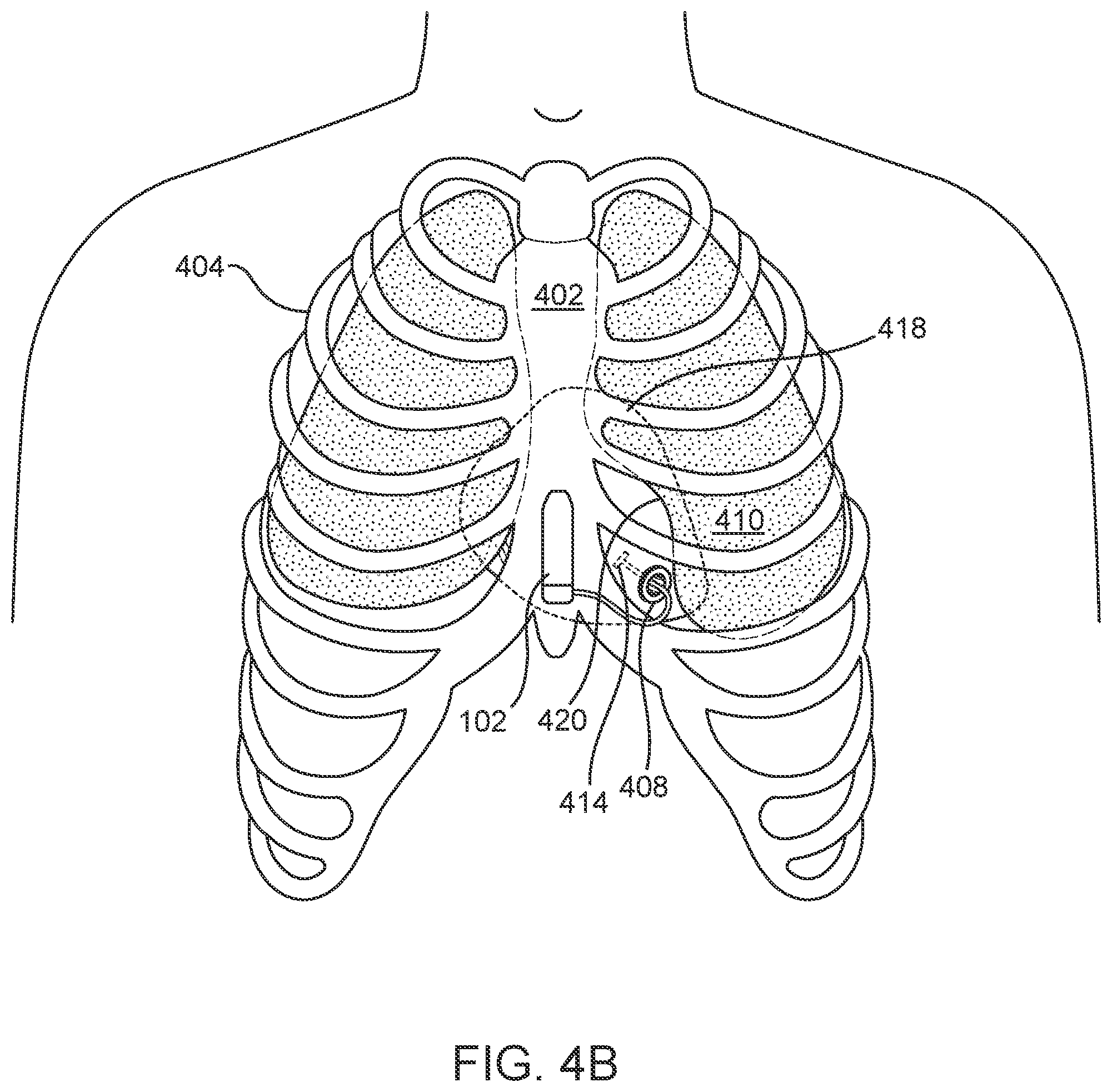 Patent US12303697 Figure 5 – Cardiac pacing sensing and control