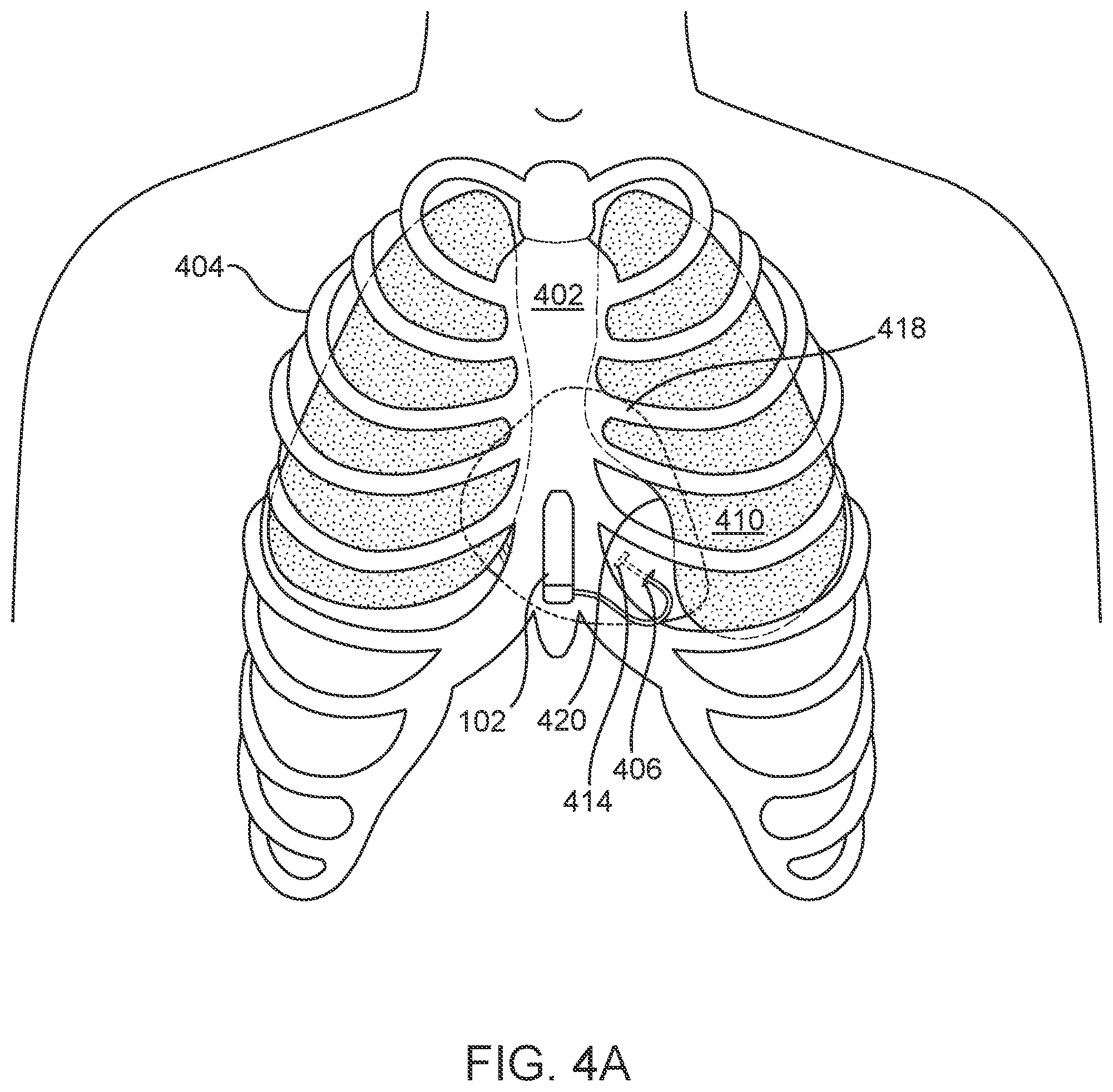 Patent US12303698 Figure 4 – Cardiac pacing sensing and control