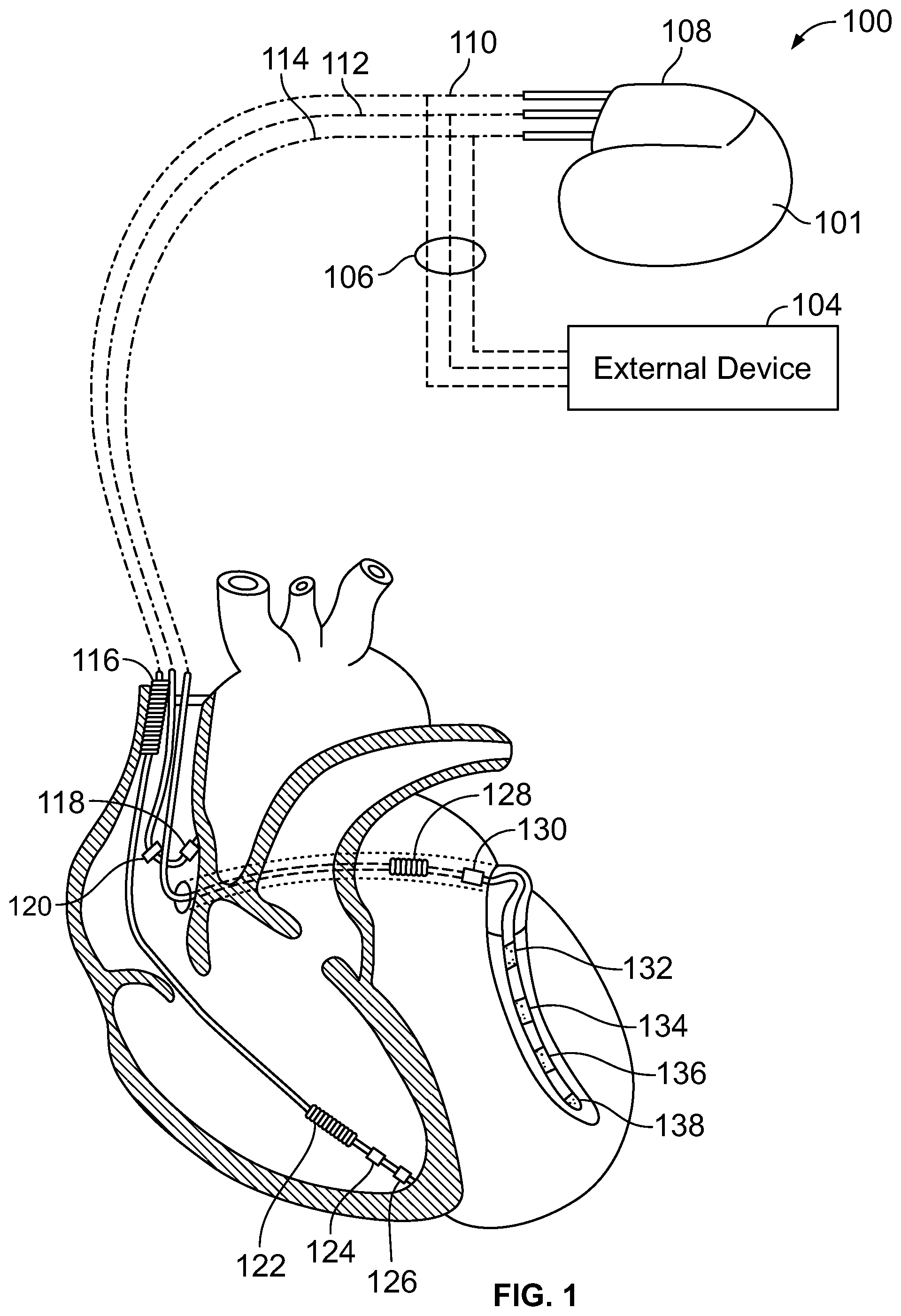 Patent US12303699 Figure 1 – Method and device for avoiding competitive atrial pacing