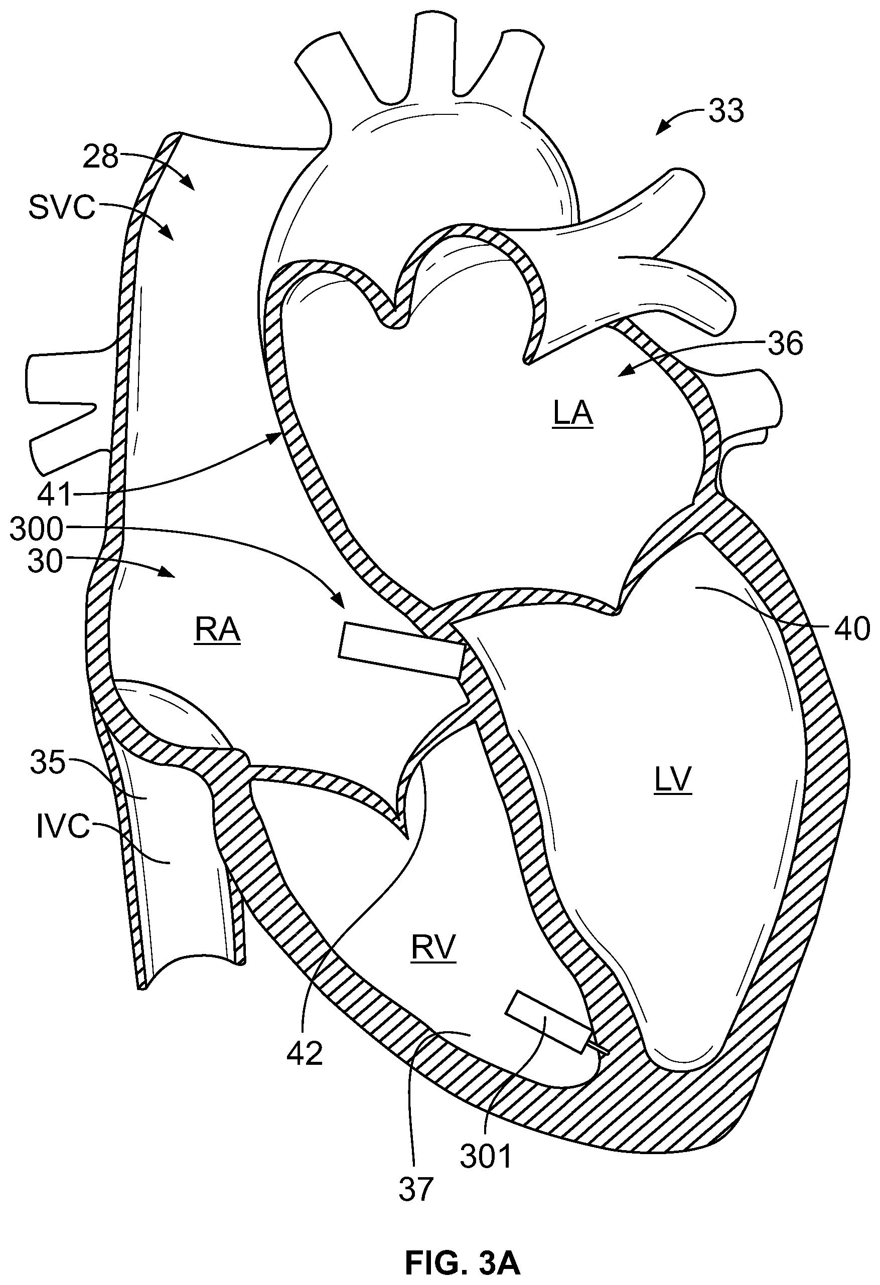 Patent US12303699 Figure 3 – Method and device for avoiding competitive atrial pacing