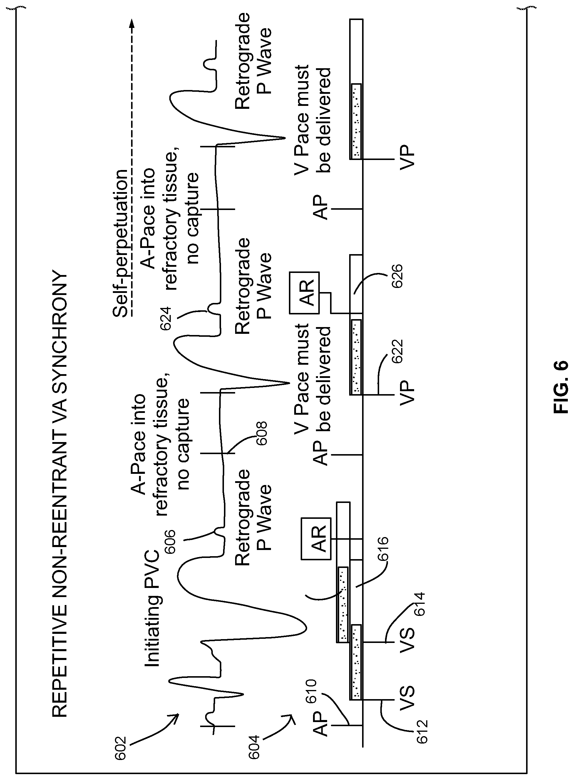 Patent US12303699 Figure 7 – Method and device for avoiding competitive atrial pacing