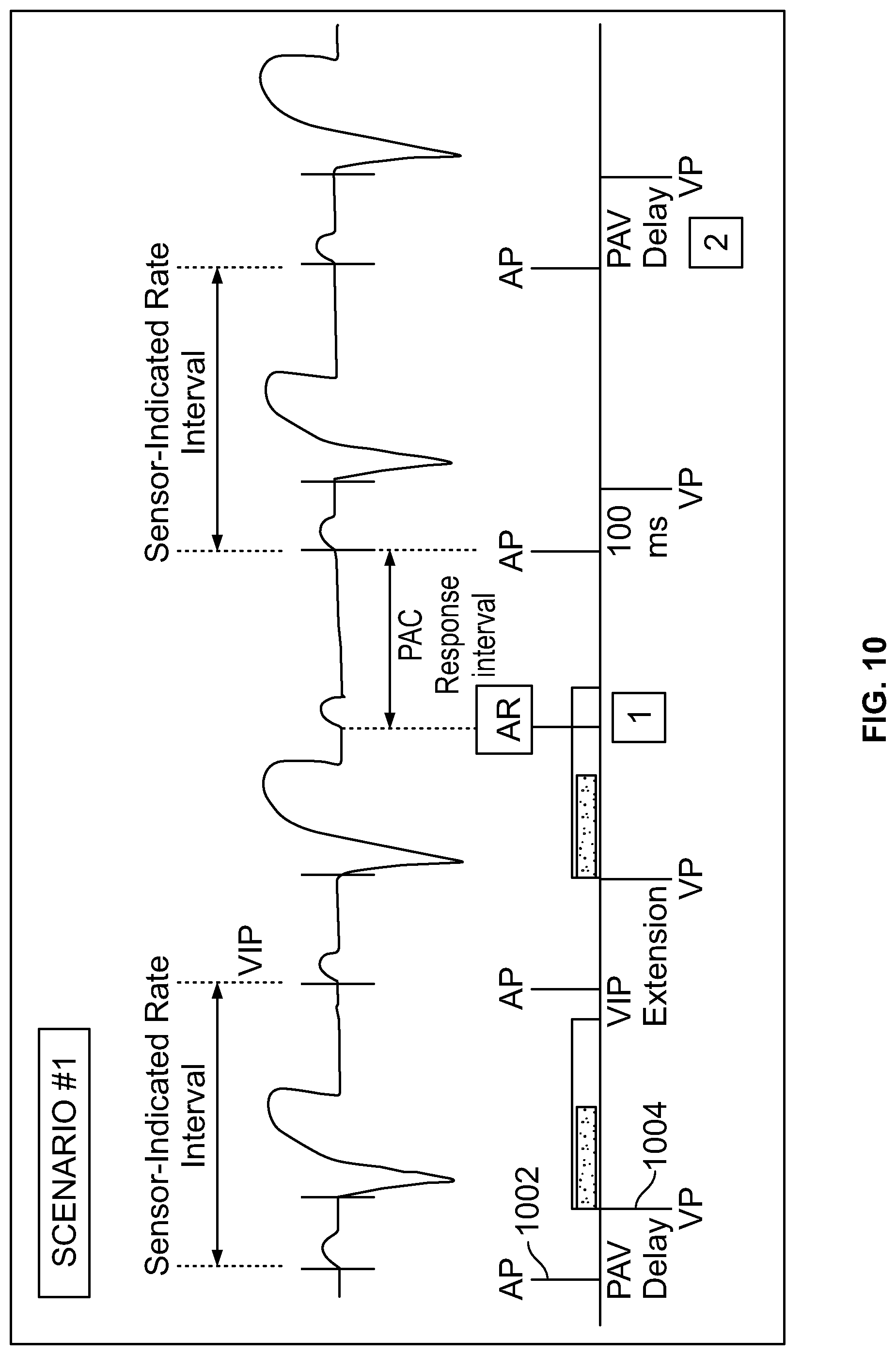 Patent US12303699 Figure 11 – Method and device for avoiding competitive atrial pacing