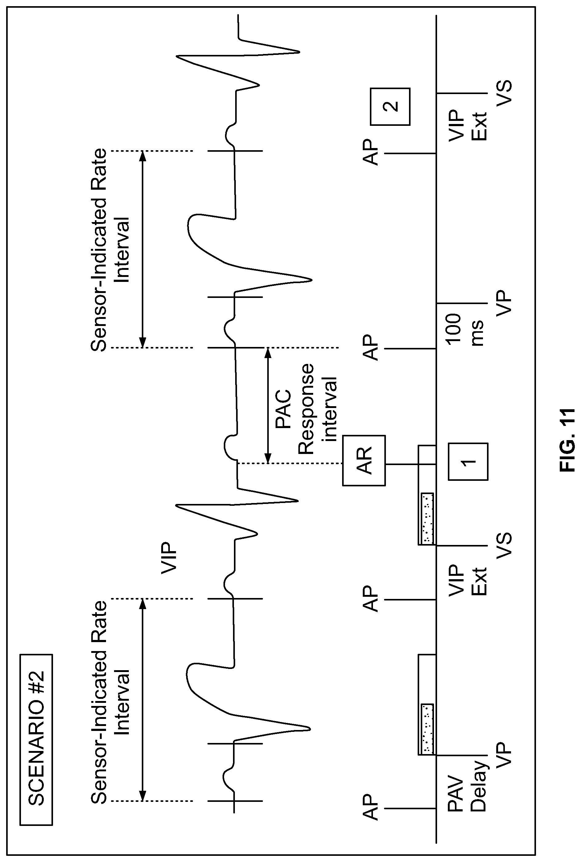 Patent US12303699 Figure 12 – Method and device for avoiding competitive atrial pacing