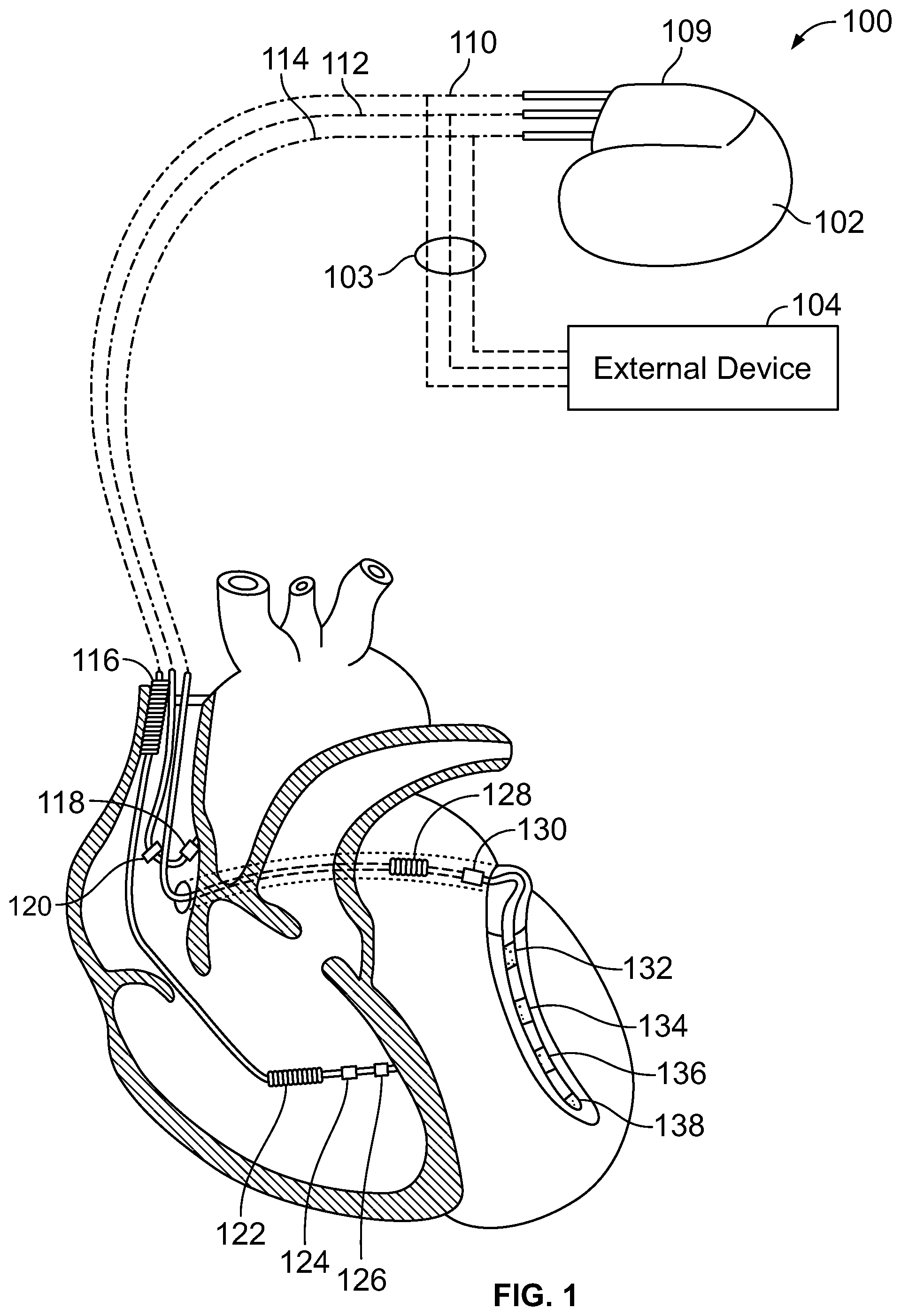 Patent US12303700 Figure 1 – Method and system for implanting a septal wall electrode