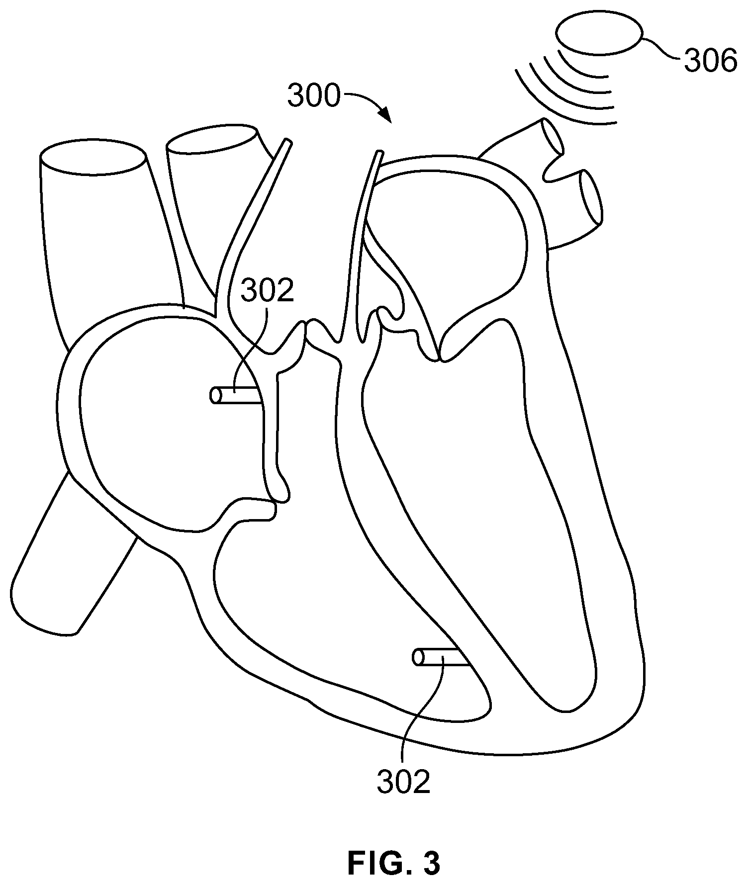 Patent US12303700 Figure 3 – Method and system for implanting a septal wall electrode