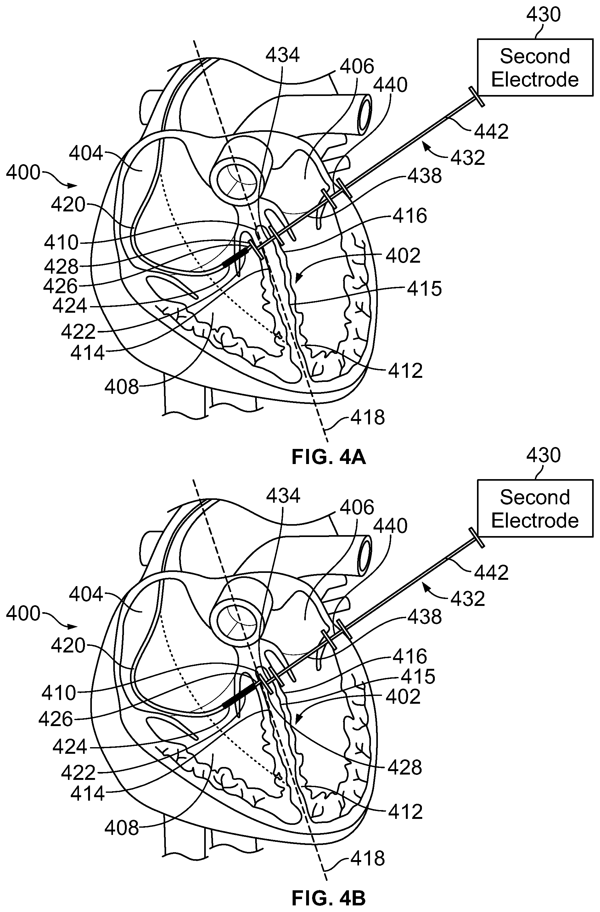 Patent US12303700 Figure 4 – Method and system for implanting a septal wall electrode