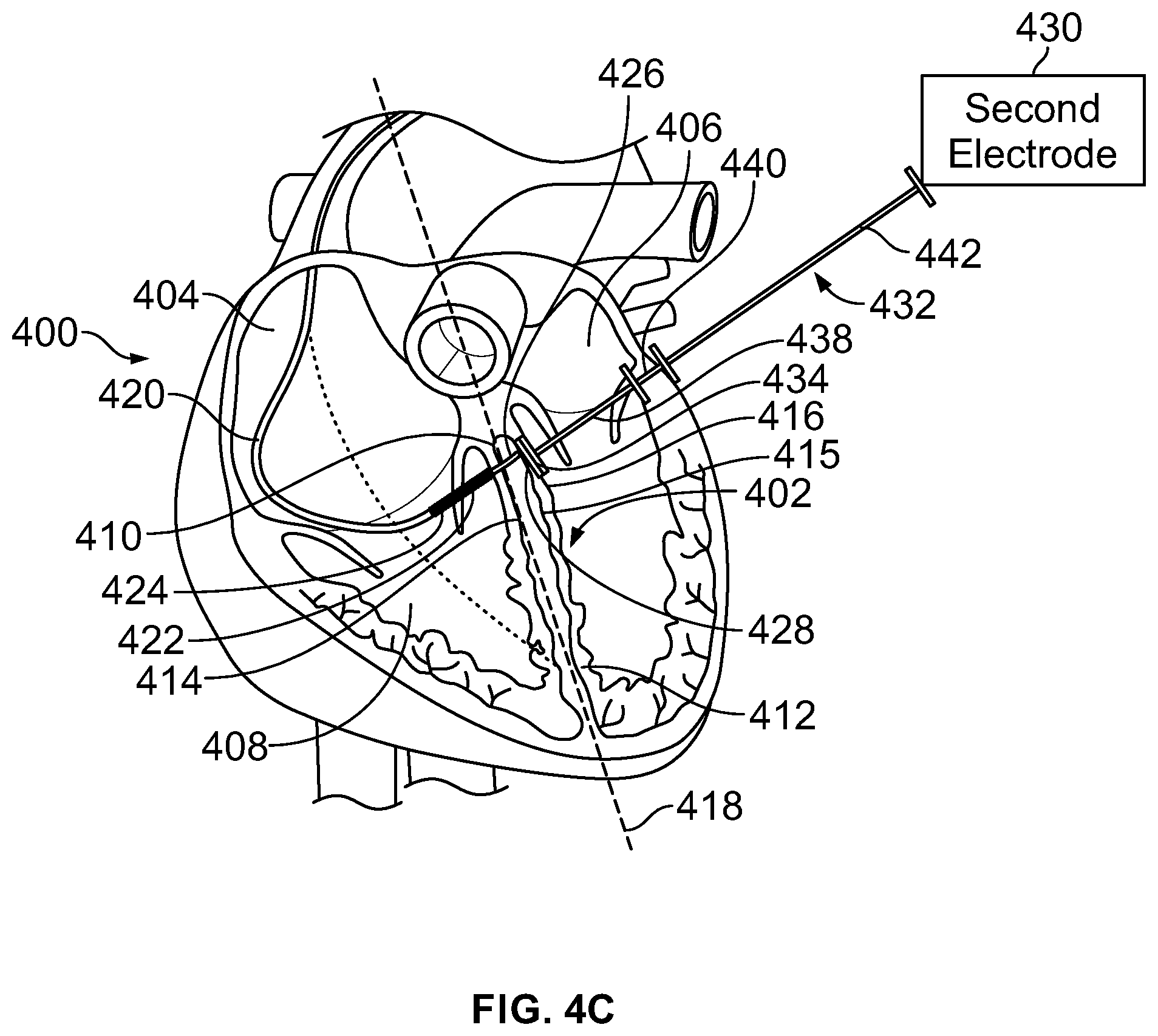 Patent US12303700 Figure 5 – Method and system for implanting a septal wall electrode