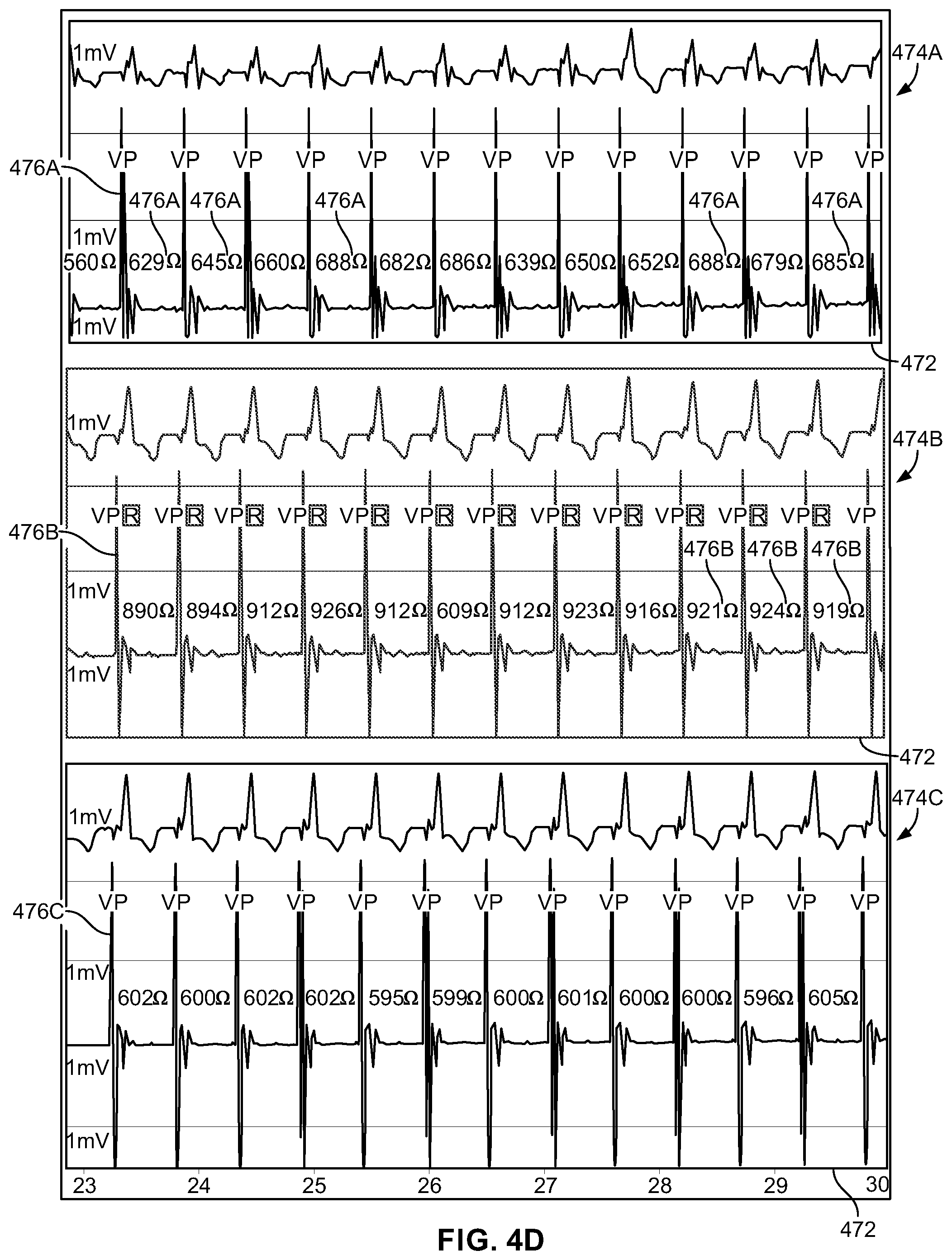 Patent US12303700 Figure 6 – Method and system for implanting a septal wall electrode