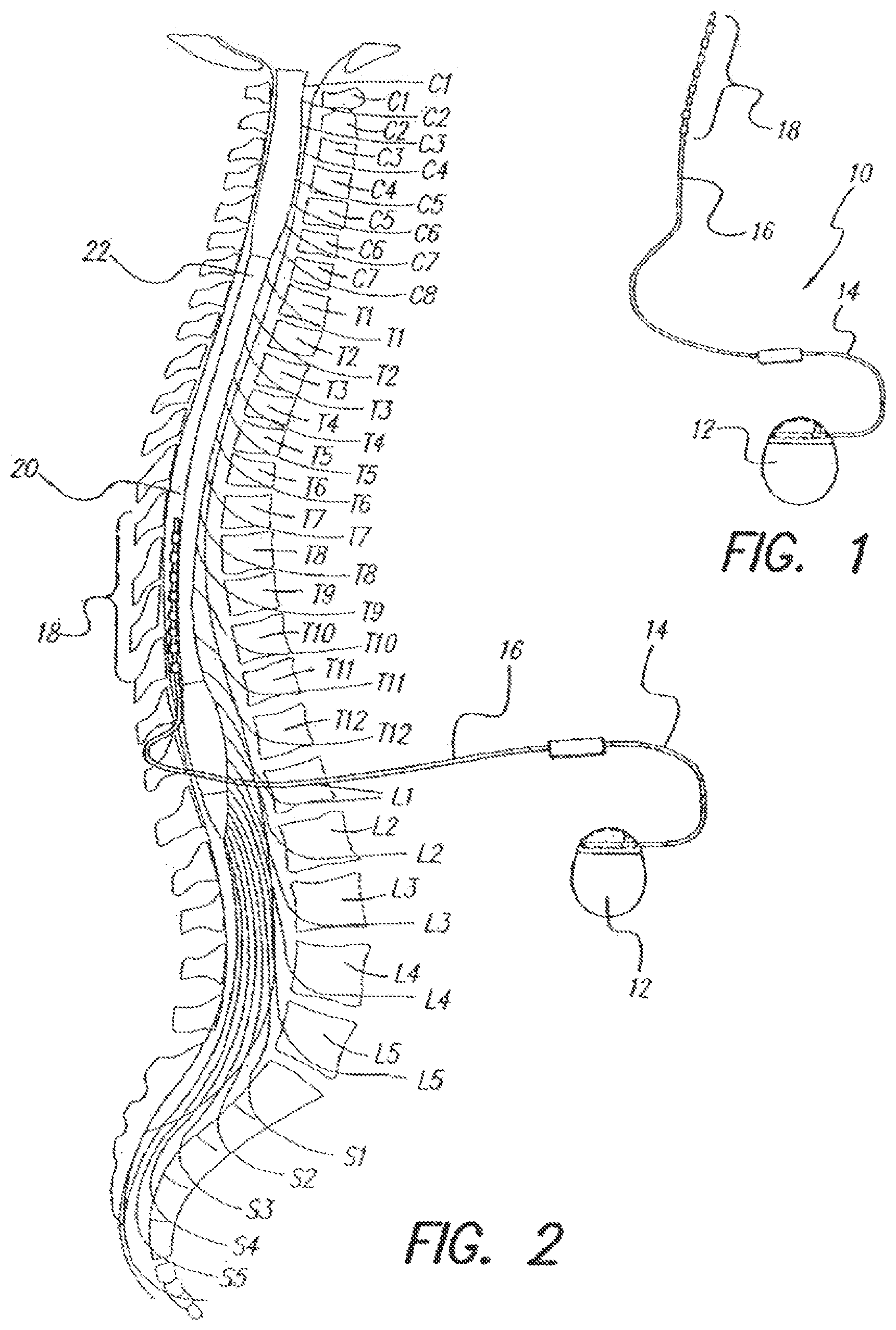 Patent US12303702 Figure 1 – Automatic adjustment to maintain evoked potential feature