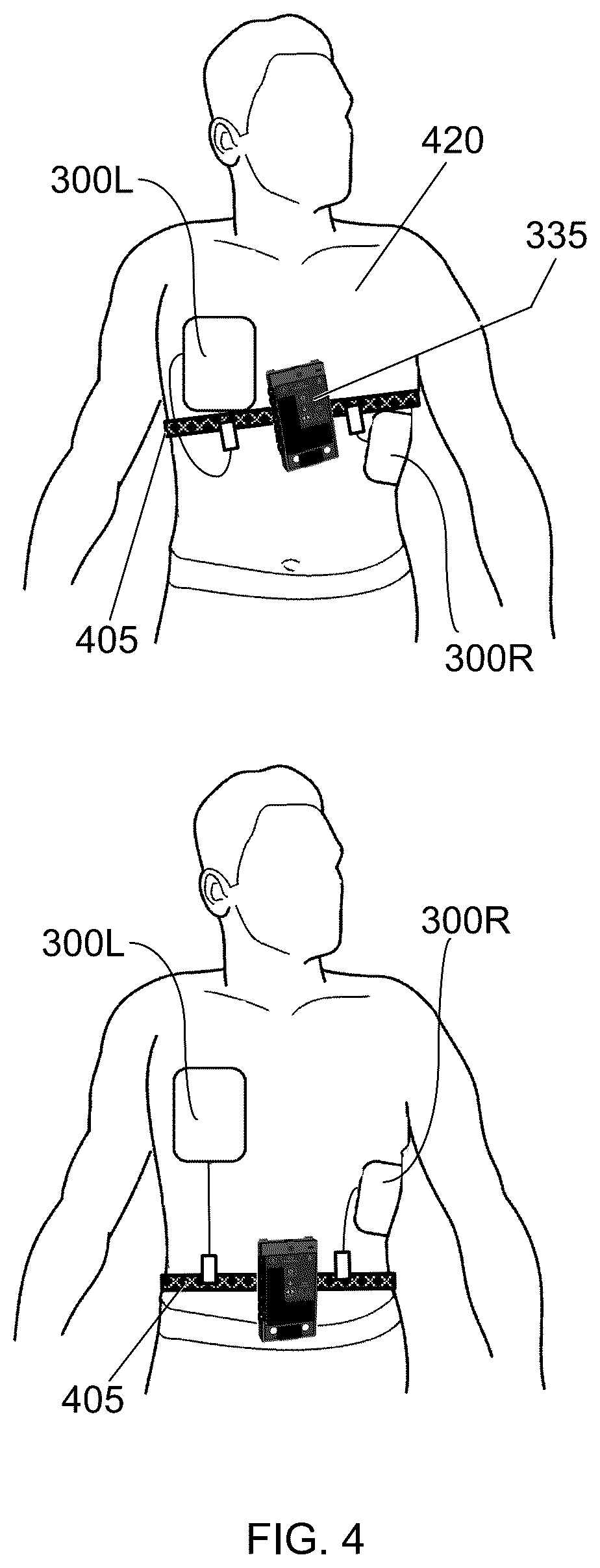 Patent US12303703 Figure 4 – Method of using a medical device