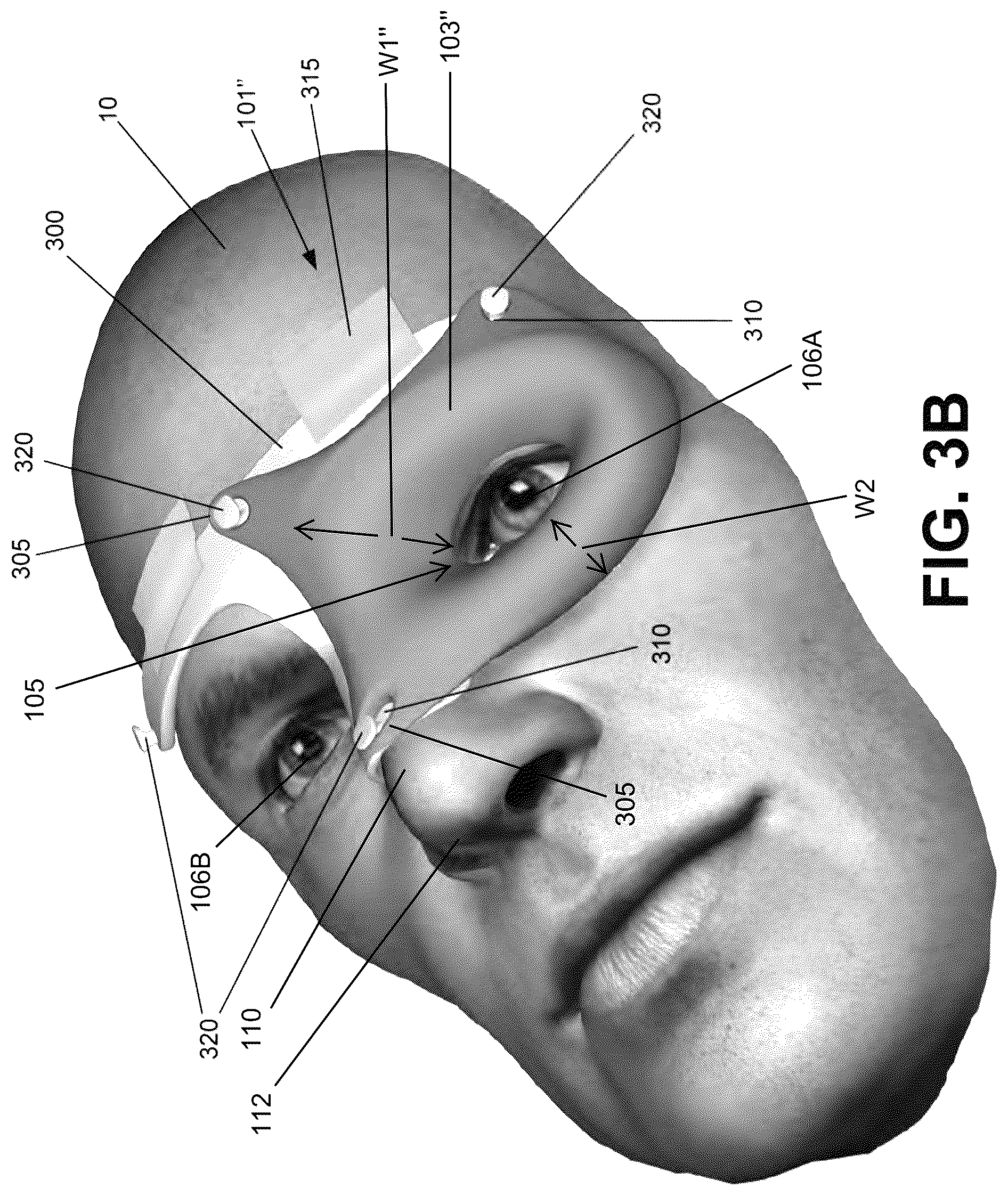 Patent US12303712 Figure 5 – Conformal system for therapeutic beta or low-energy gamma radiation shielding
