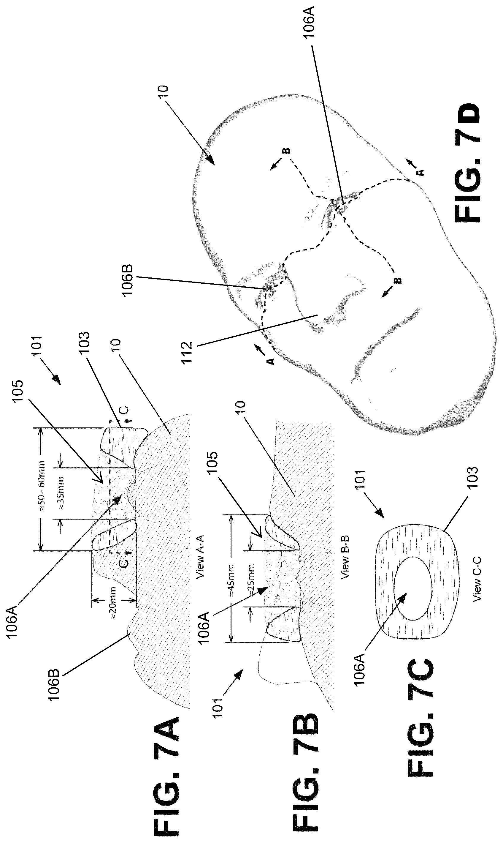 Patent US12303712 Figure 10 – Conformal system for therapeutic beta or low-energy gamma radiation shielding