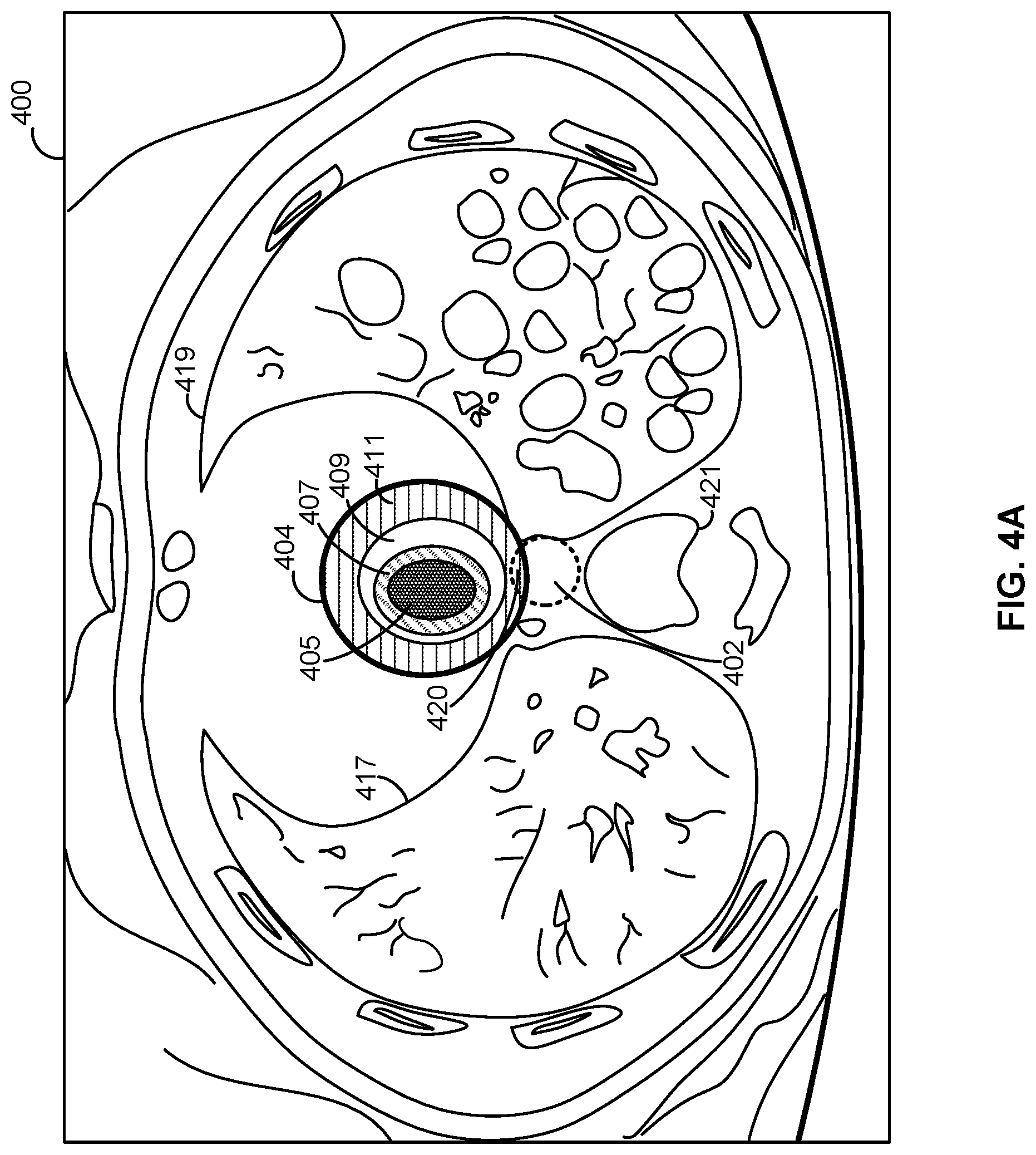 Patent US12303715 Figure 4 – Methods and apparatus for automatically determining radioablation treatment risk
