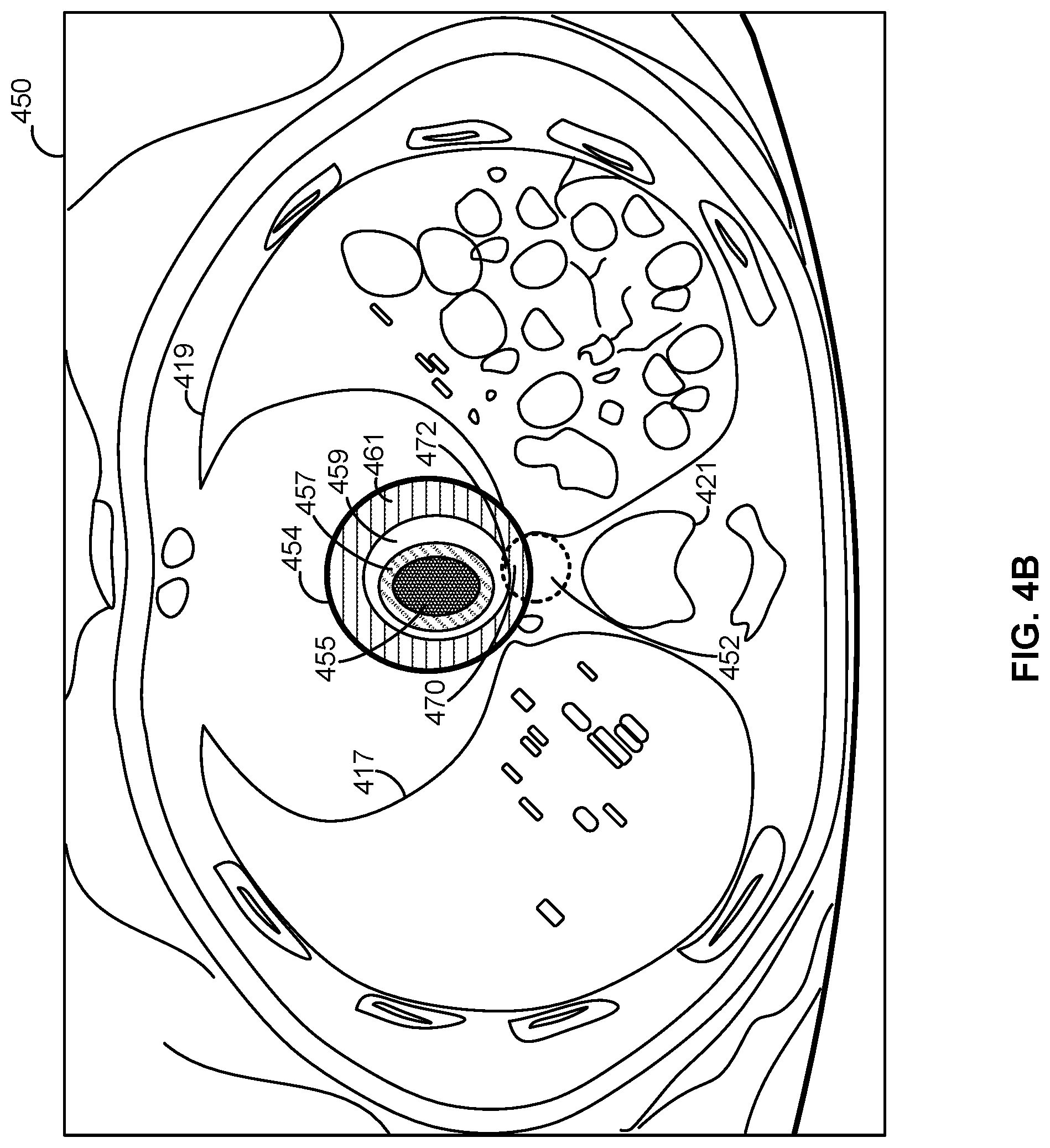 Patent US12303715 Figure 5 – Methods and apparatus for automatically determining radioablation treatment risk