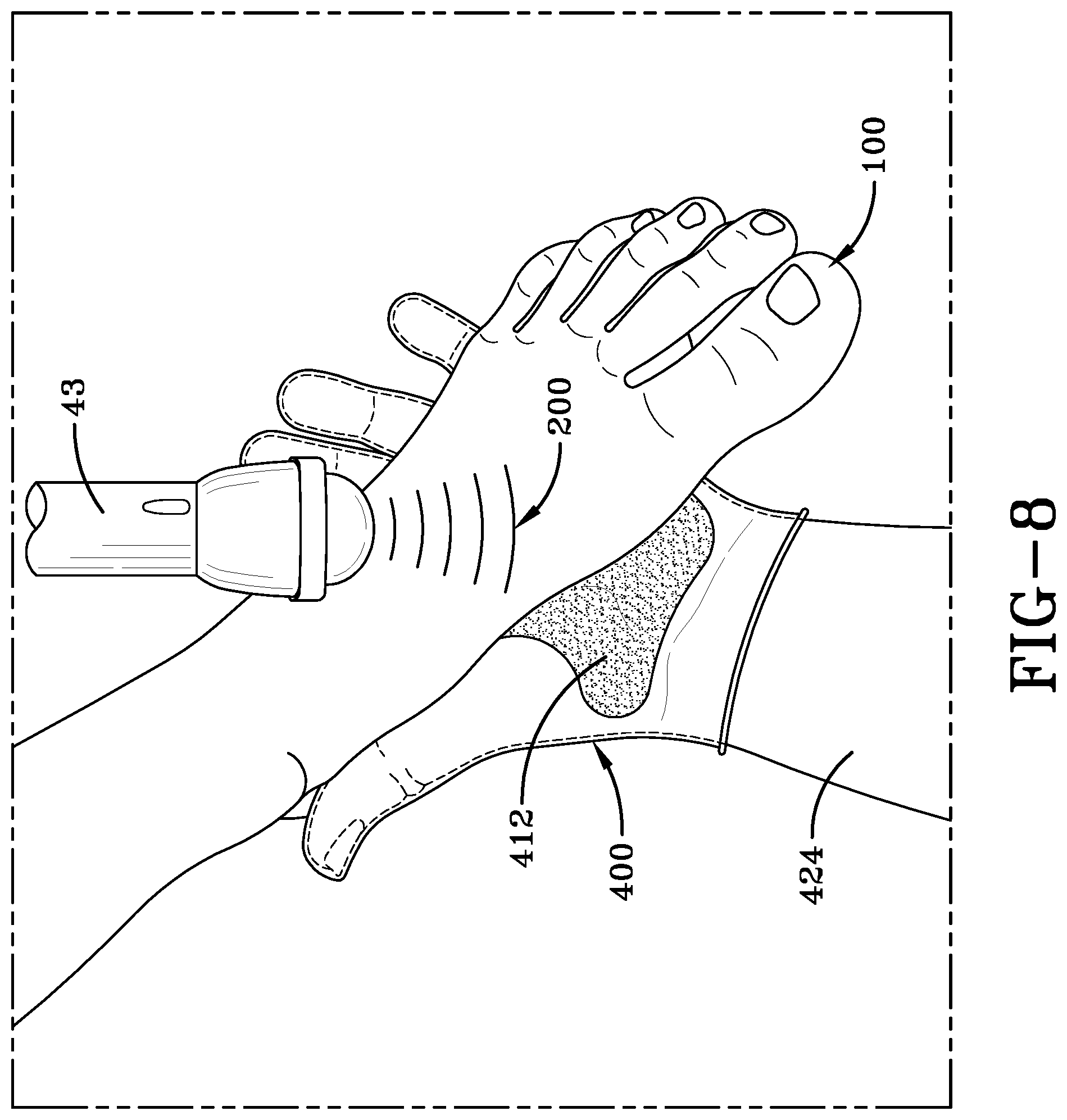 Patent US12303721 Figure 5 – Acoustic shock wave treatment and devices for appendages
