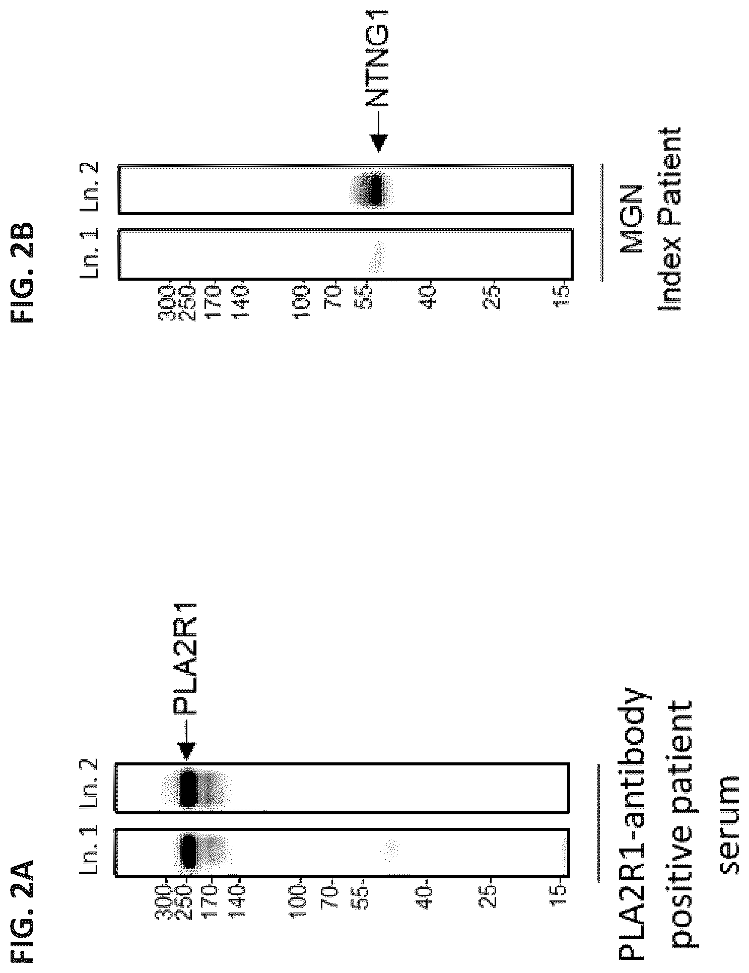 Patent US12306184 Figure 2 – Biomarkers of membranous glomerulonephritis