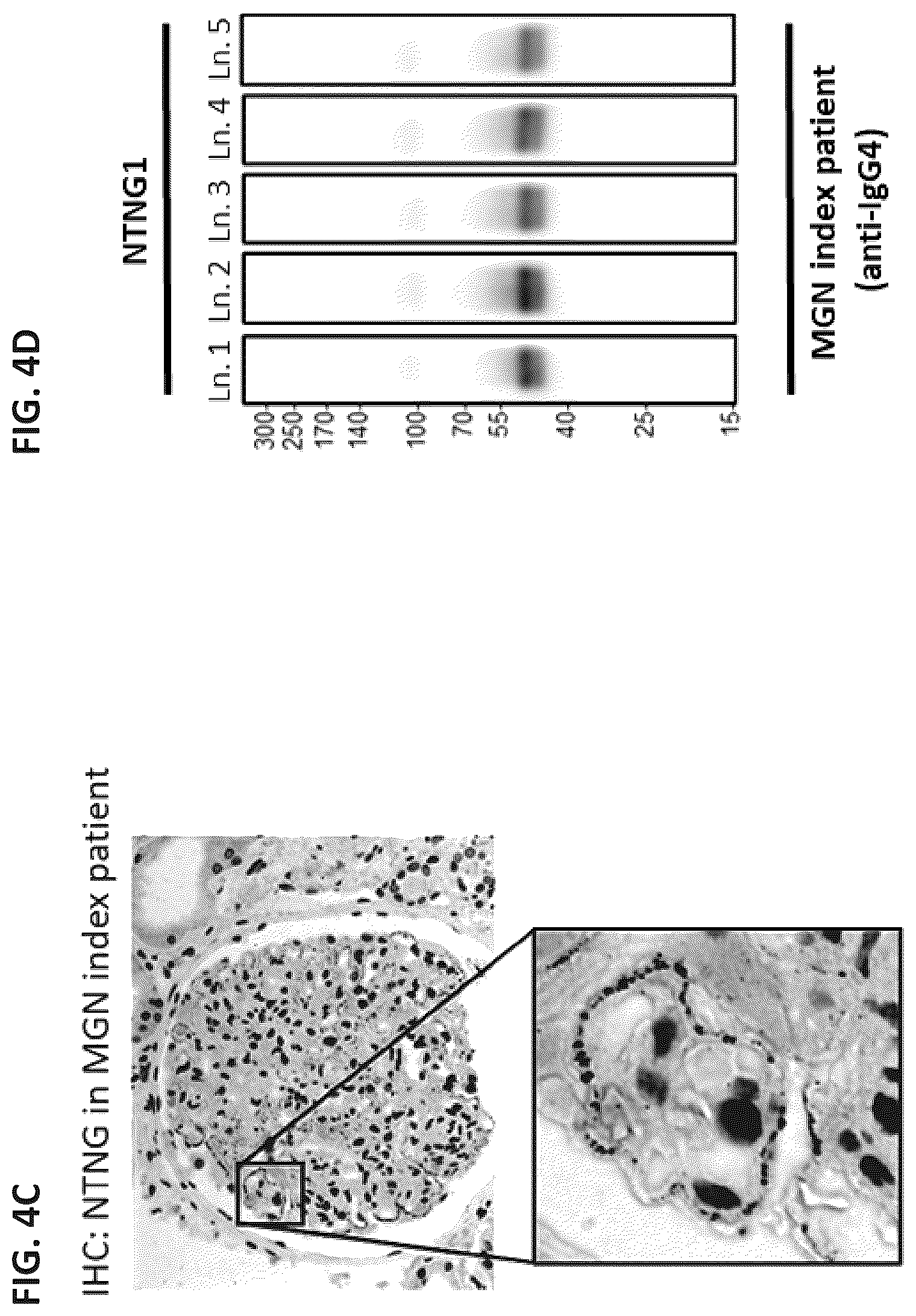 Patent US12306184 Figure 5 – Biomarkers of membranous glomerulonephritis