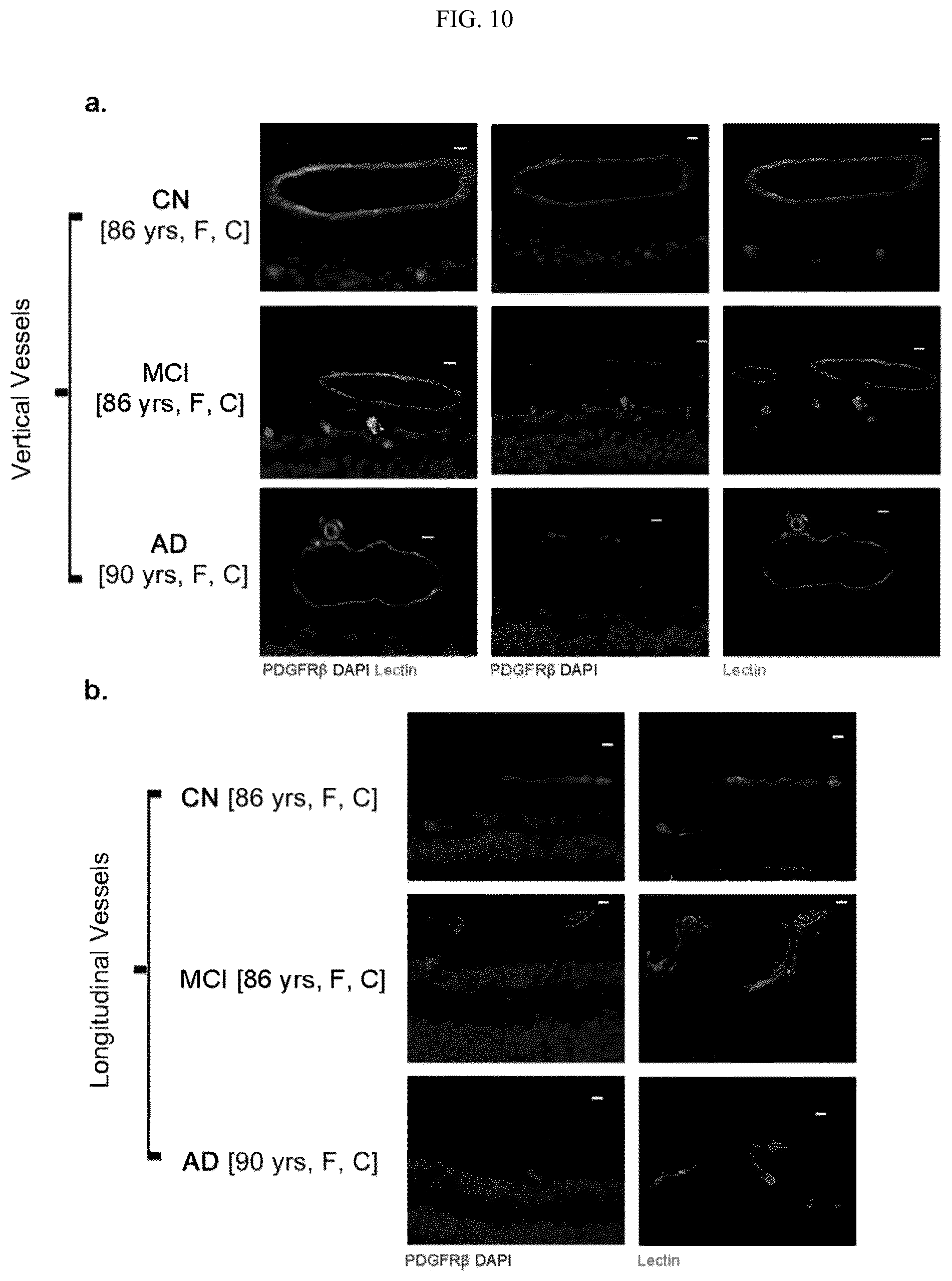 Patent US12306192 Figure 10 – Method of detecting cognitive impairment