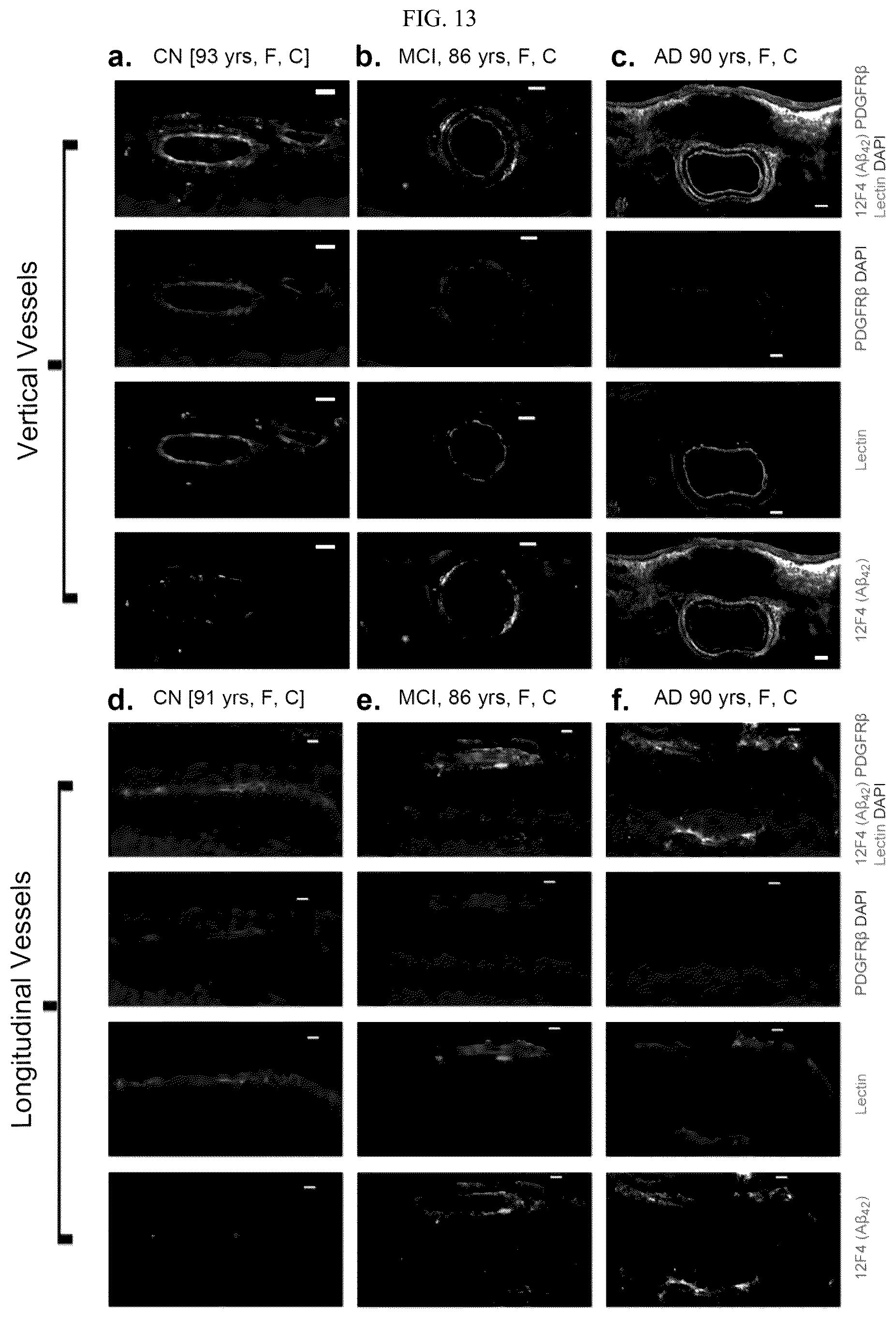 Patent US12306192 Figure 14 – Method of detecting cognitive impairment