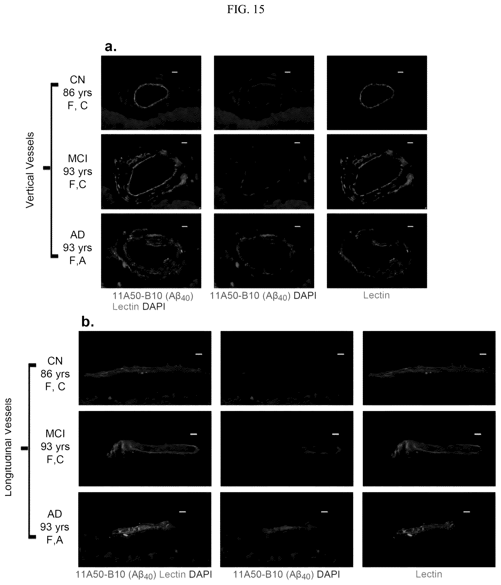 Patent US12306192 Figure 16 – Method of detecting cognitive impairment