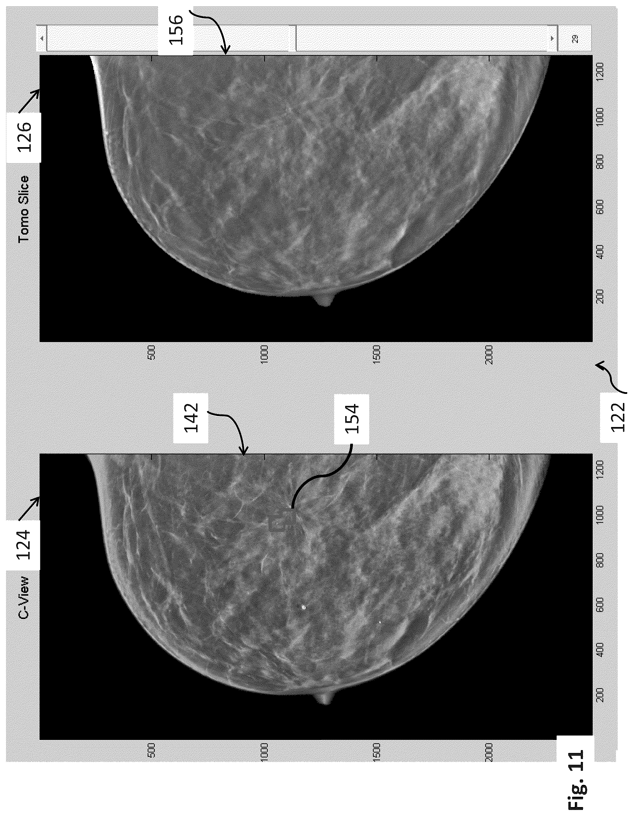 Patent US12307604 Figure 11 – System and method for navigating a tomosynthesis stack using synthesized image data