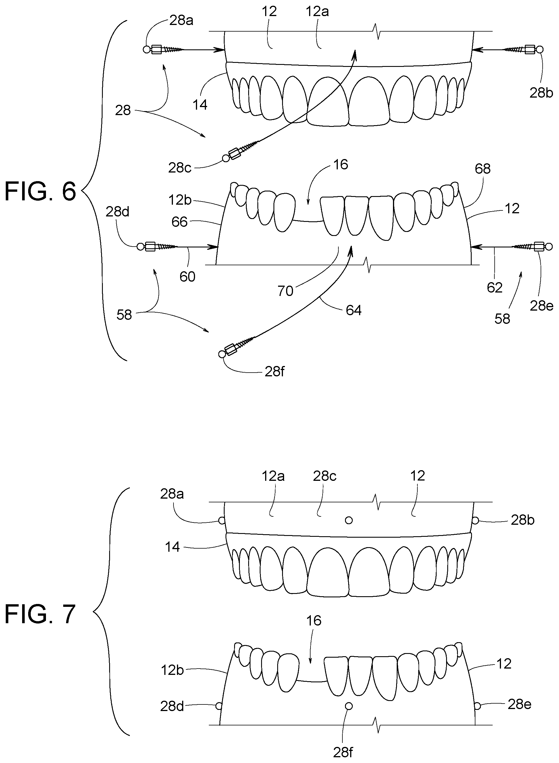 Patent US12307656 Figure 3 – Computer assisted dental methods for analyzing jaws