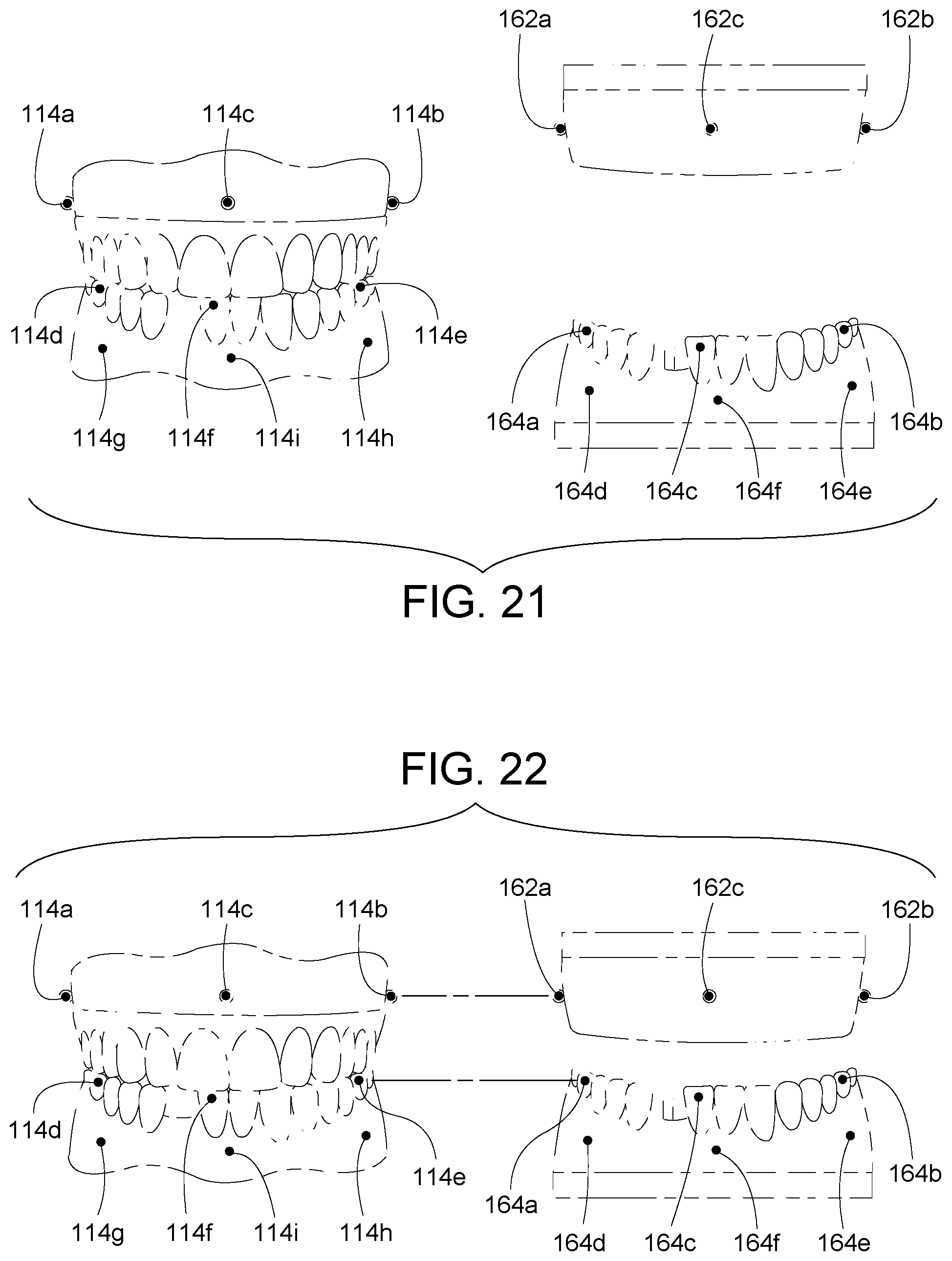 Patent US12307656 Figure 11 – Computer assisted dental methods for analyzing jaws