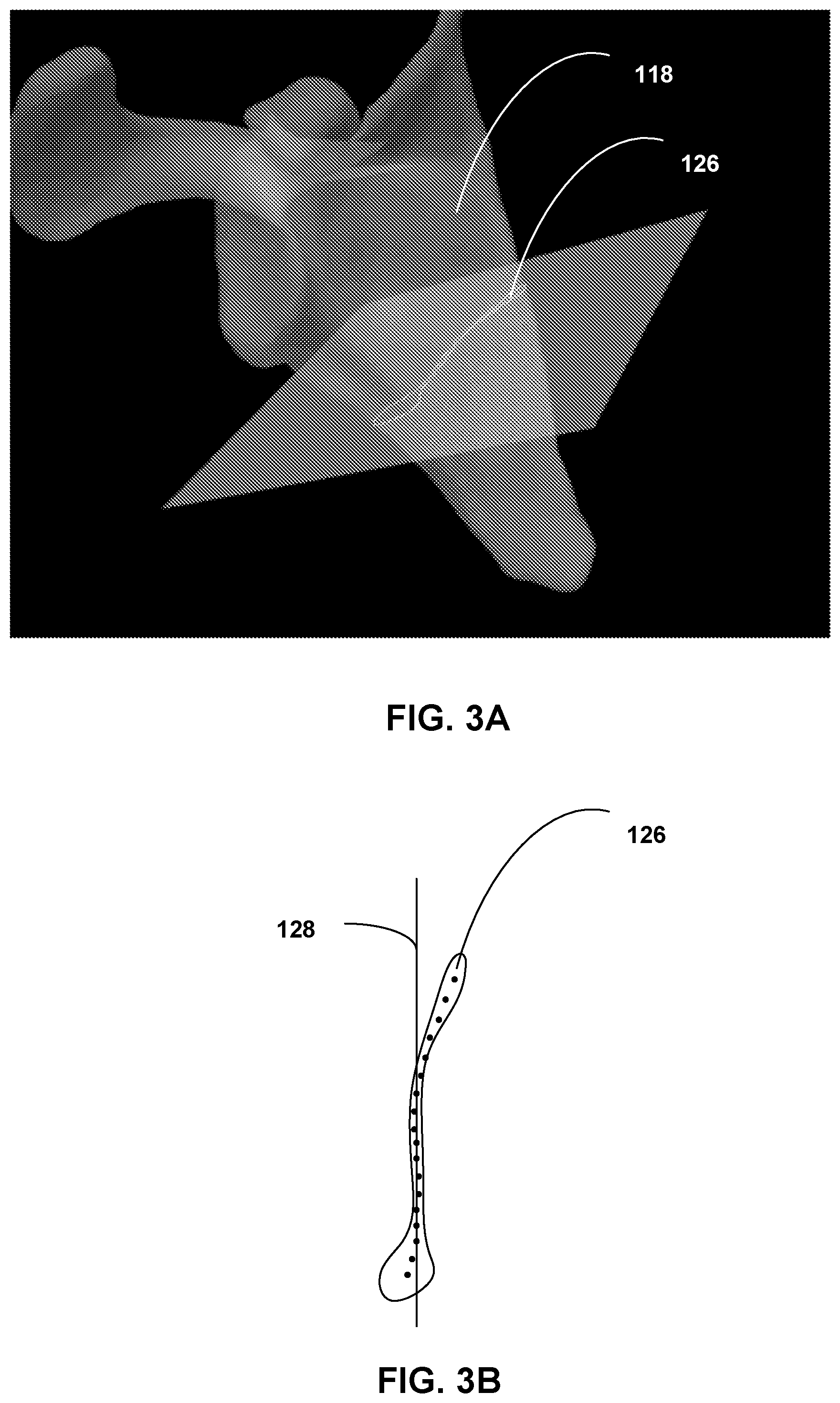 Patent US12307658 Figure 3 – Pre-morbid characterization of anatomical object using statistical shape modeling (SSM)
