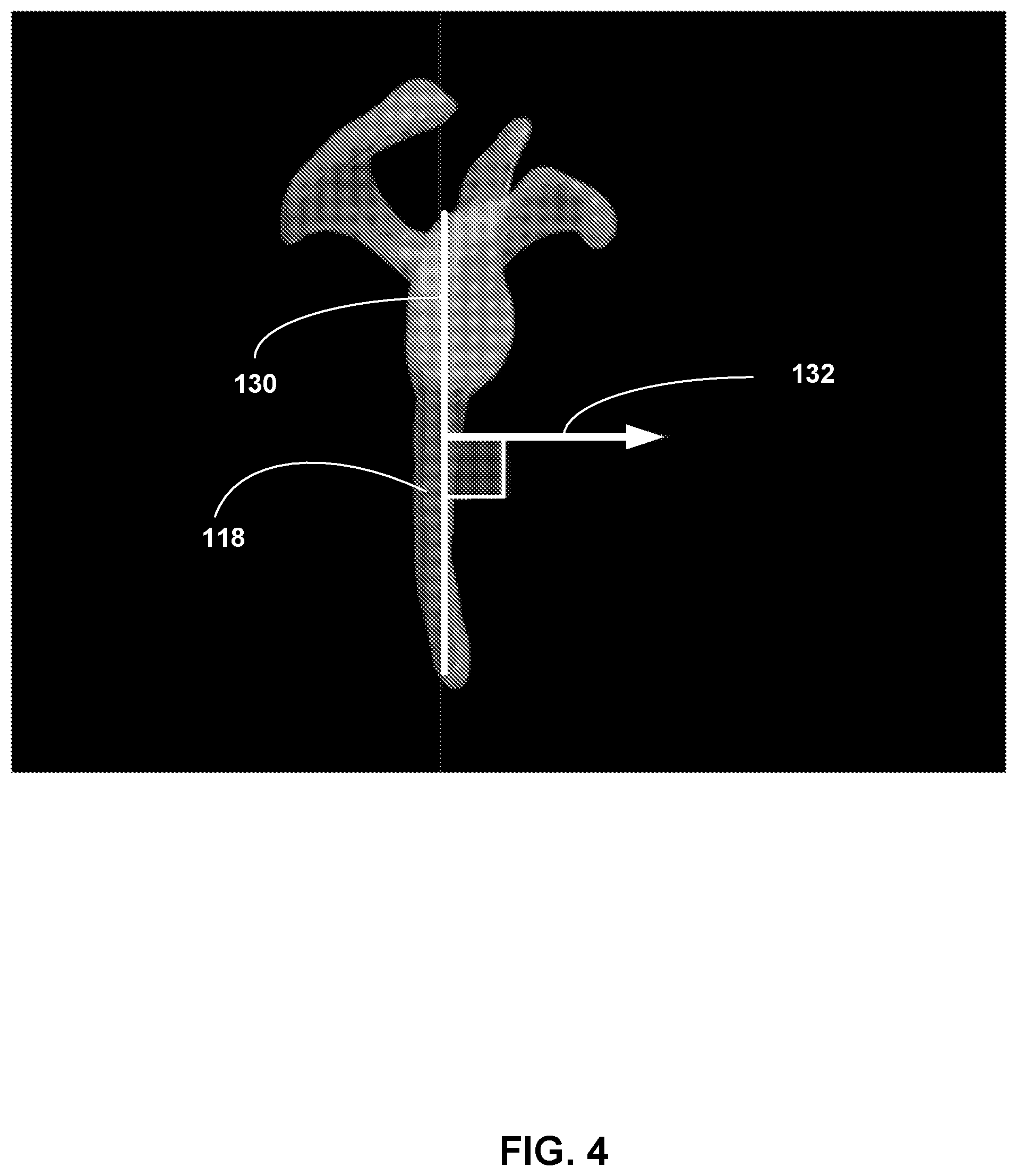 Patent US12307658 Figure 4 – Pre-morbid characterization of anatomical object using statistical shape modeling (SSM)