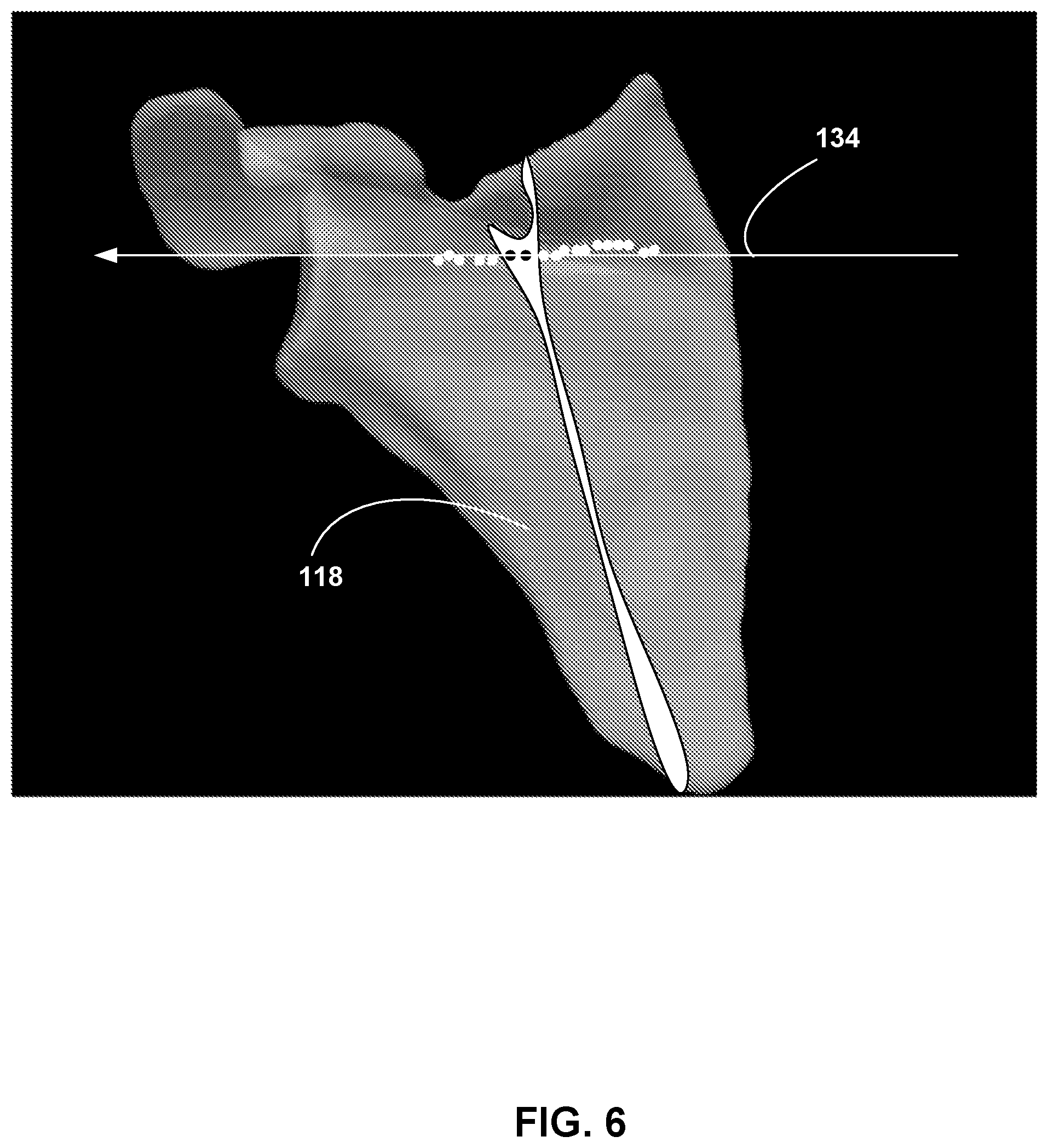 Patent US12307658 Figure 6 – Pre-morbid characterization of anatomical object using statistical shape modeling (SSM)