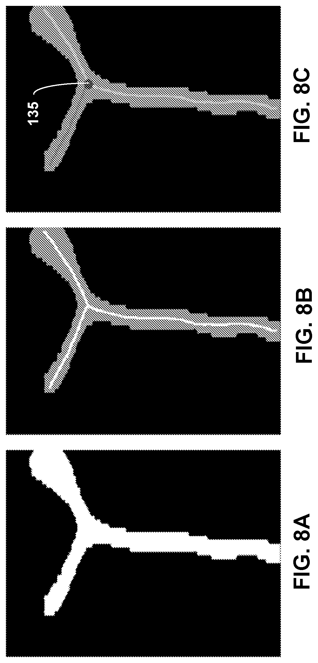 Patent US12307658 Figure 8 – Pre-morbid characterization of anatomical object using statistical shape modeling (SSM)