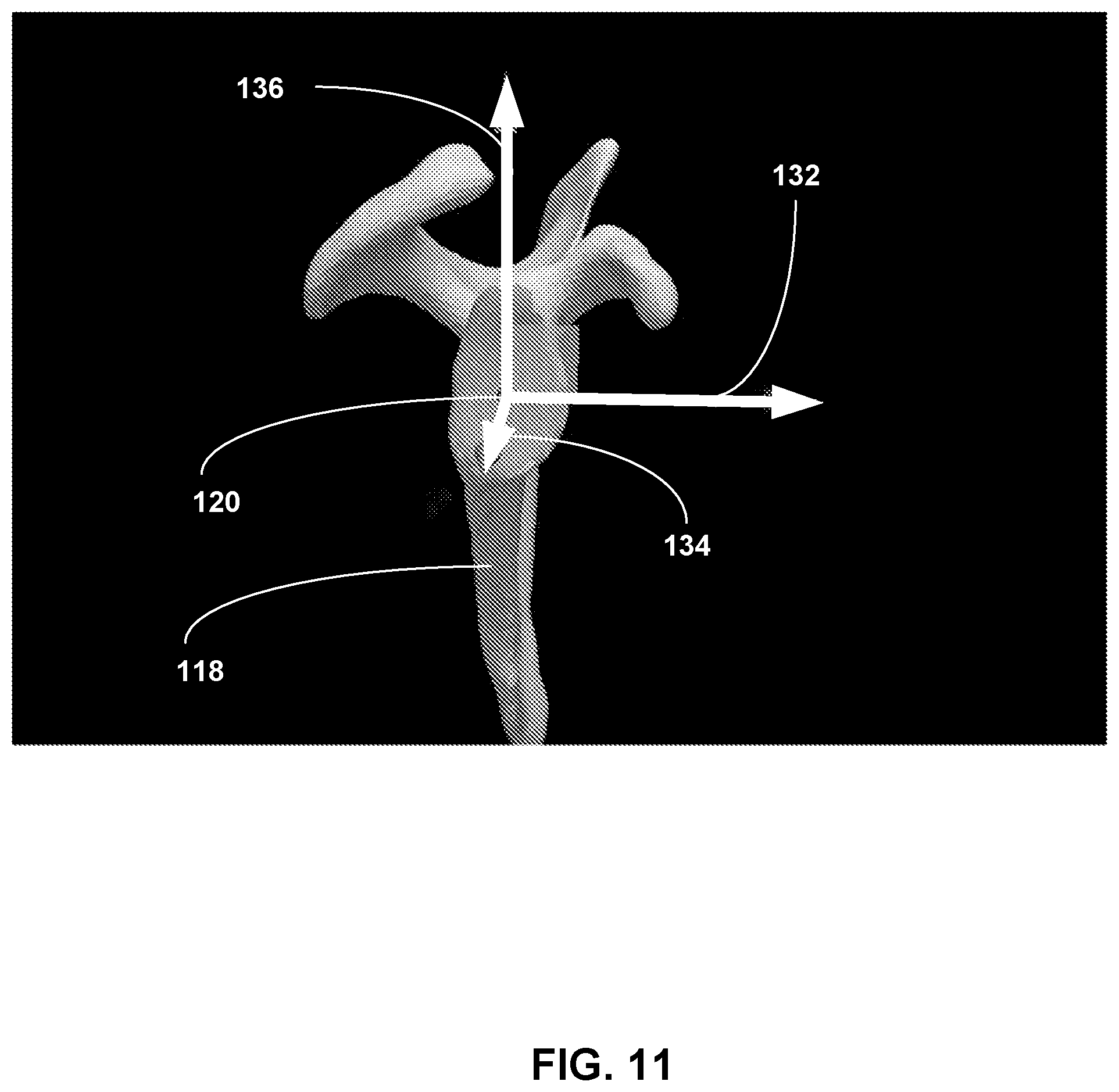 Patent US12307658 Figure 11 – Pre-morbid characterization of anatomical object using statistical shape modeling (SSM)