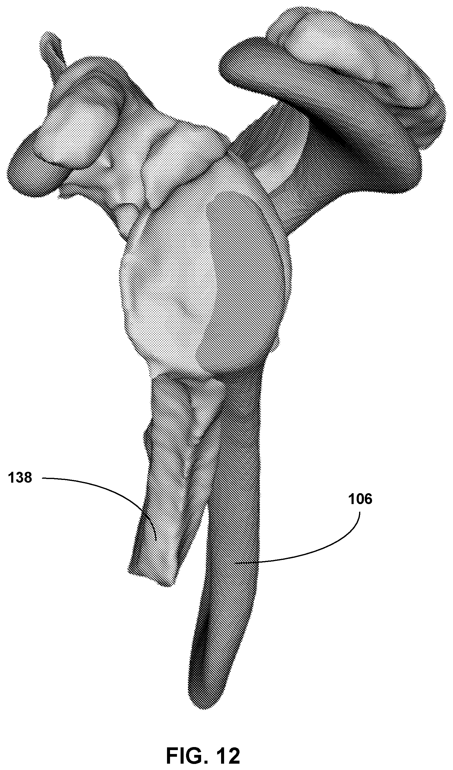 Patent US12307658 Figure 12 – Pre-morbid characterization of anatomical object using statistical shape modeling (SSM)