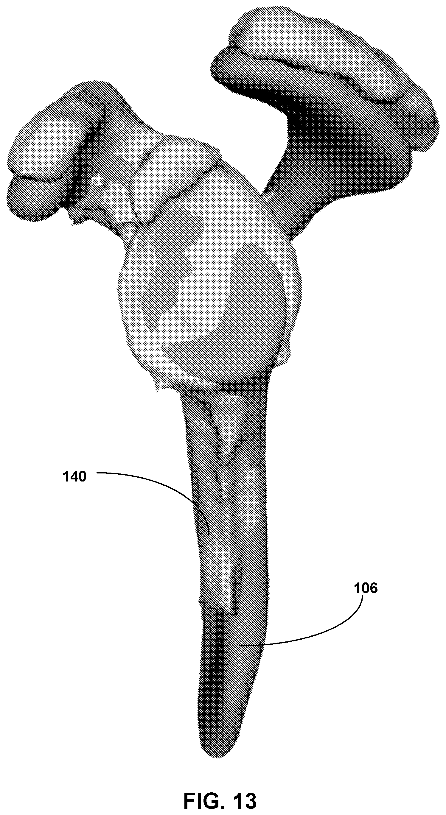 Patent US12307658 Figure 13 – Pre-morbid characterization of anatomical object using statistical shape modeling (SSM)