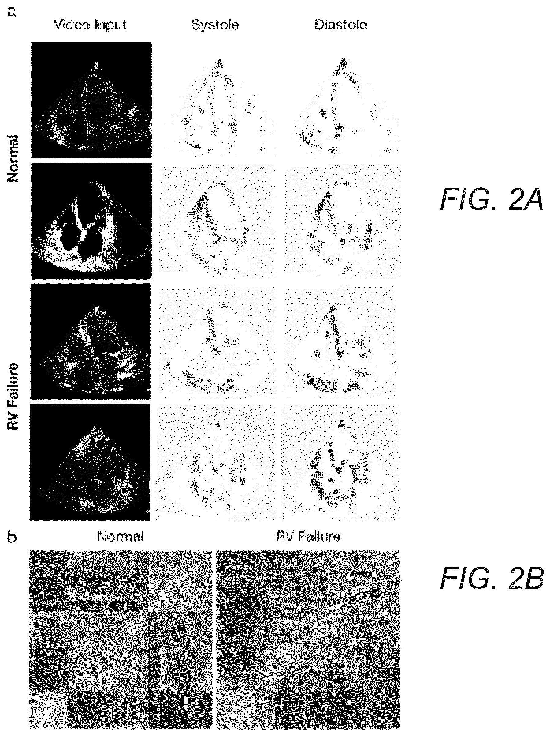 Patent US12307666 Figure 2 – Systems and methods for predicting post-operative right ventricular failure using echocardiograms